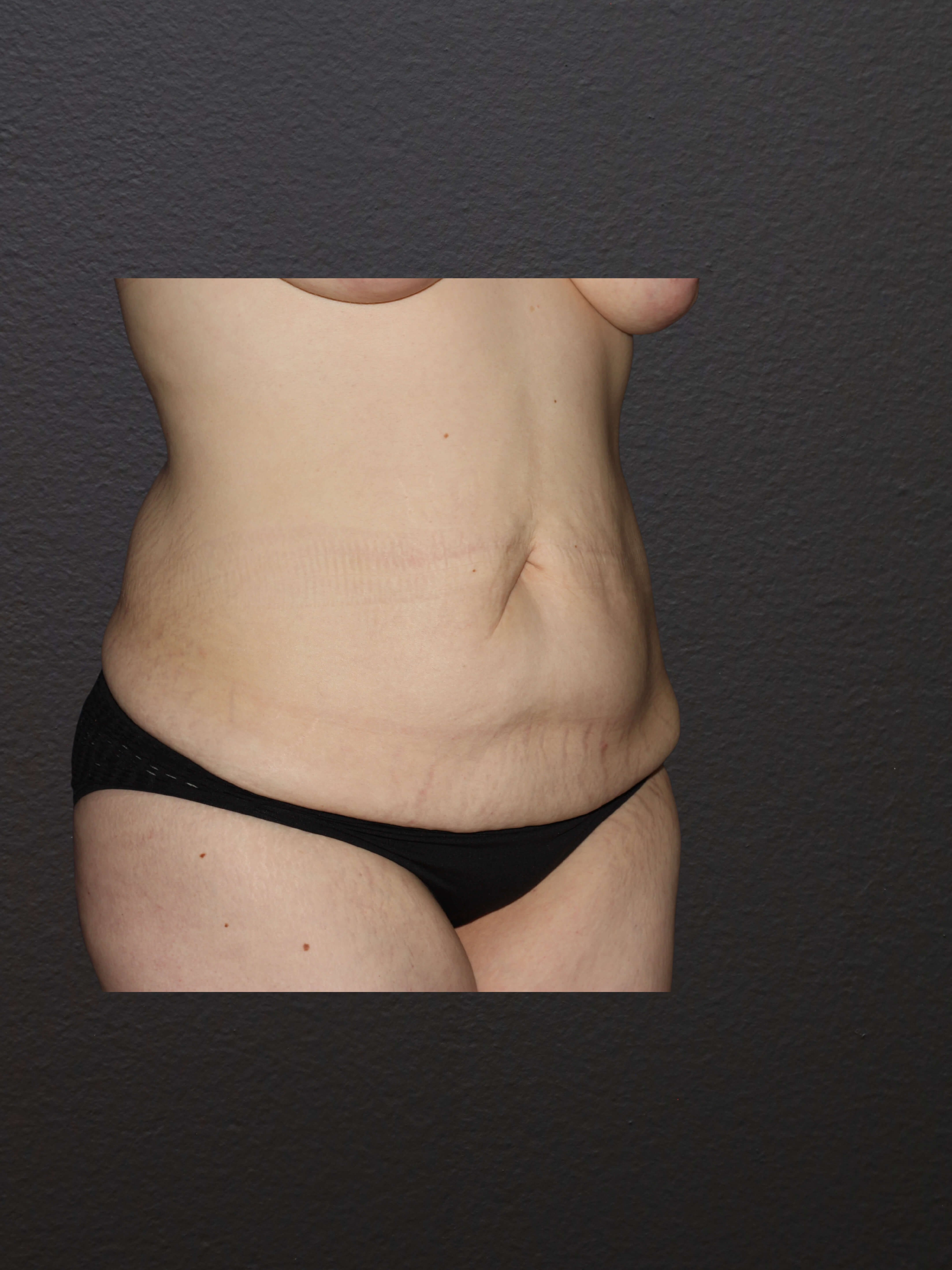 RIGHT OBLIQUE Before