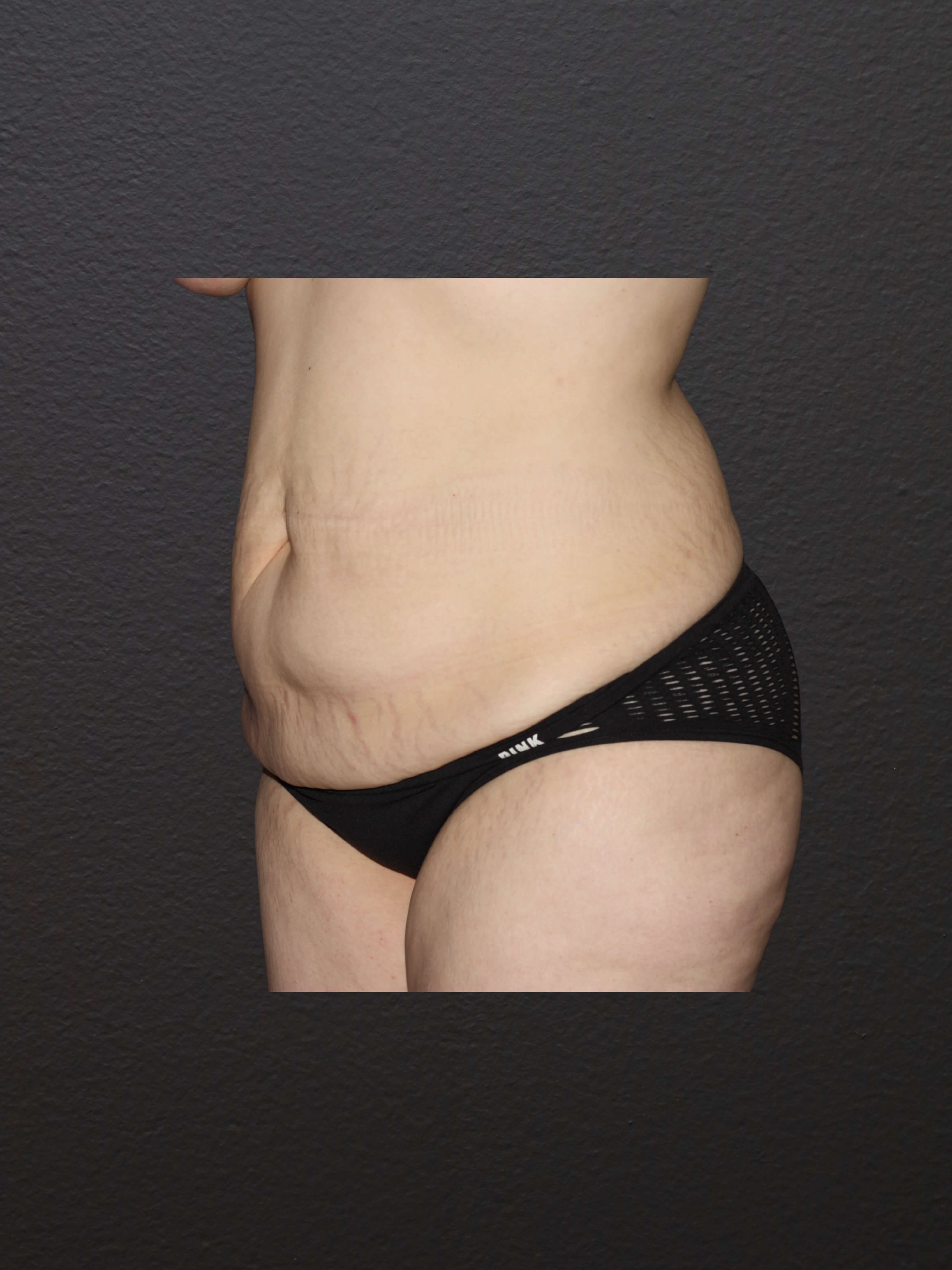 LEFT OBLIQUE Before