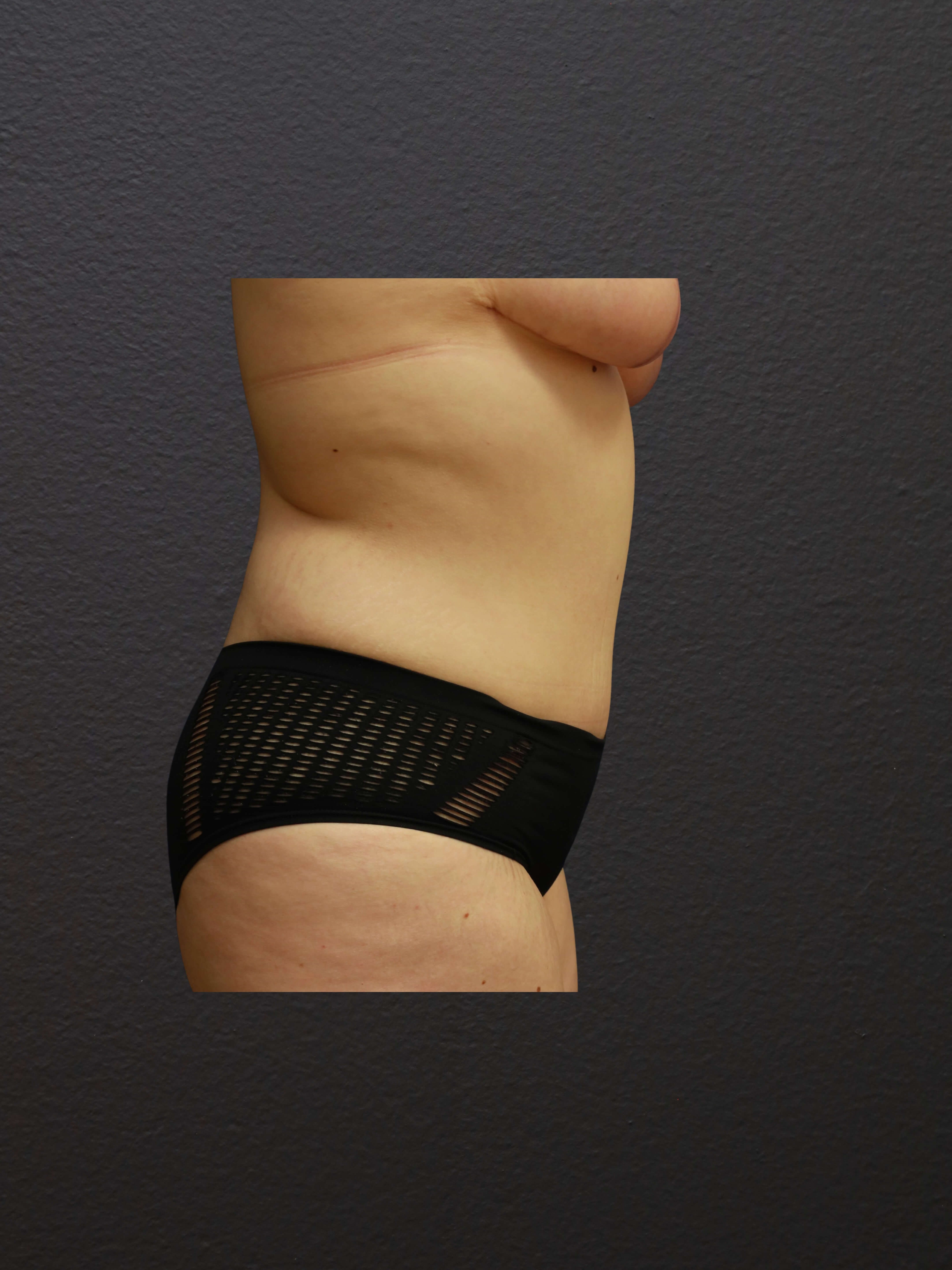 RIGHT LATERAL After