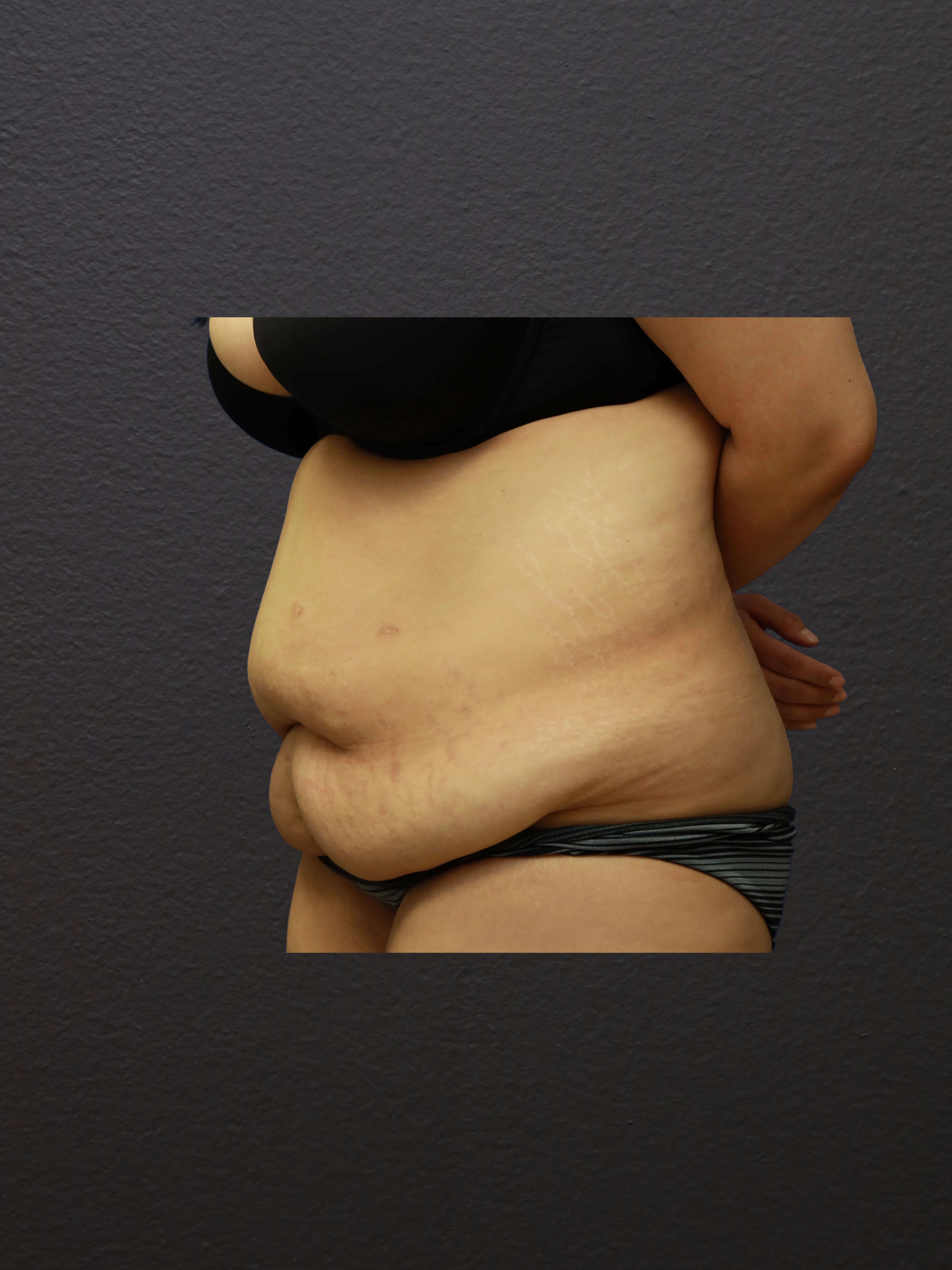 LEFT OBLIQUE Before
