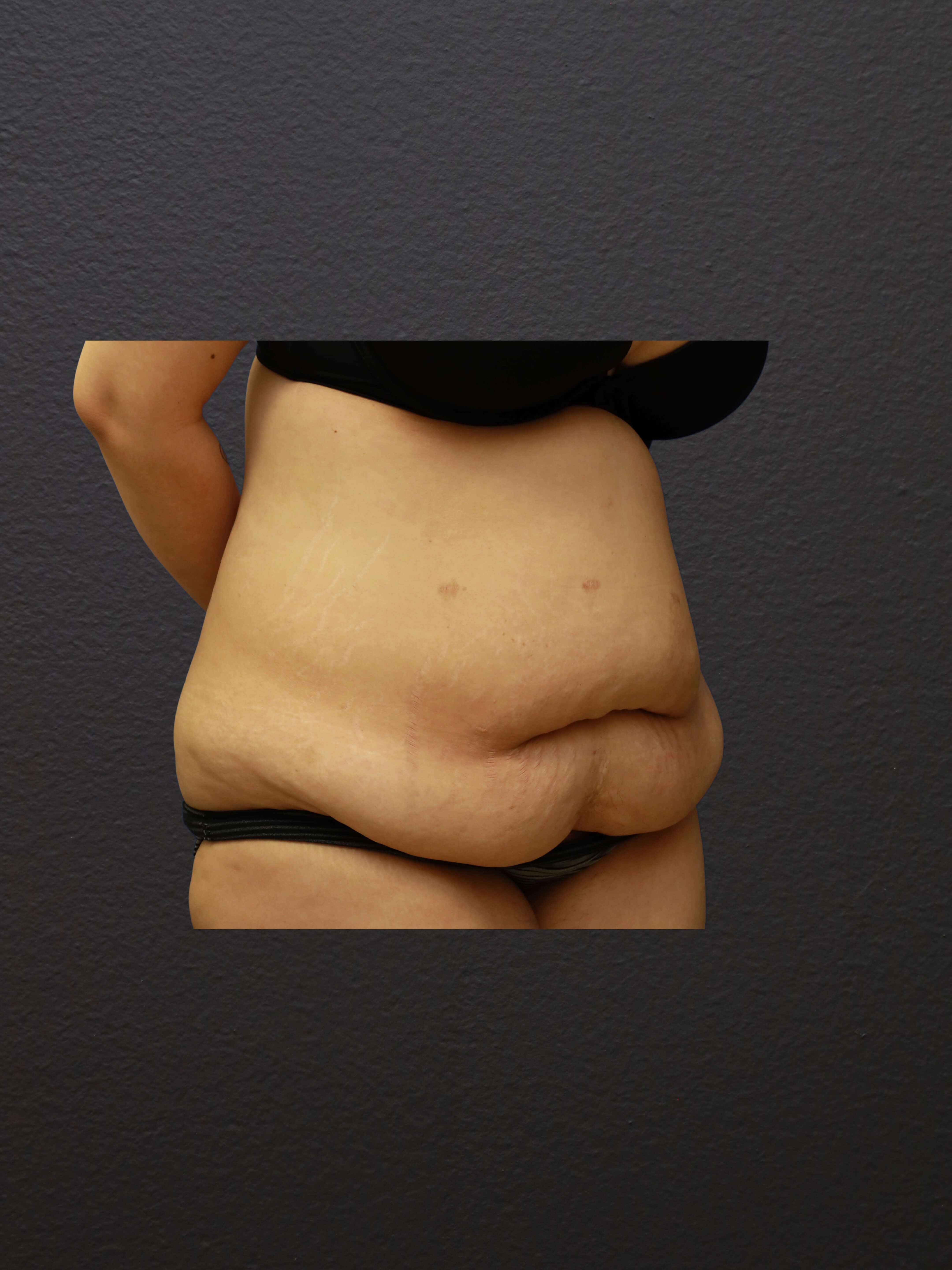 RIGHT OBLIQUE Before