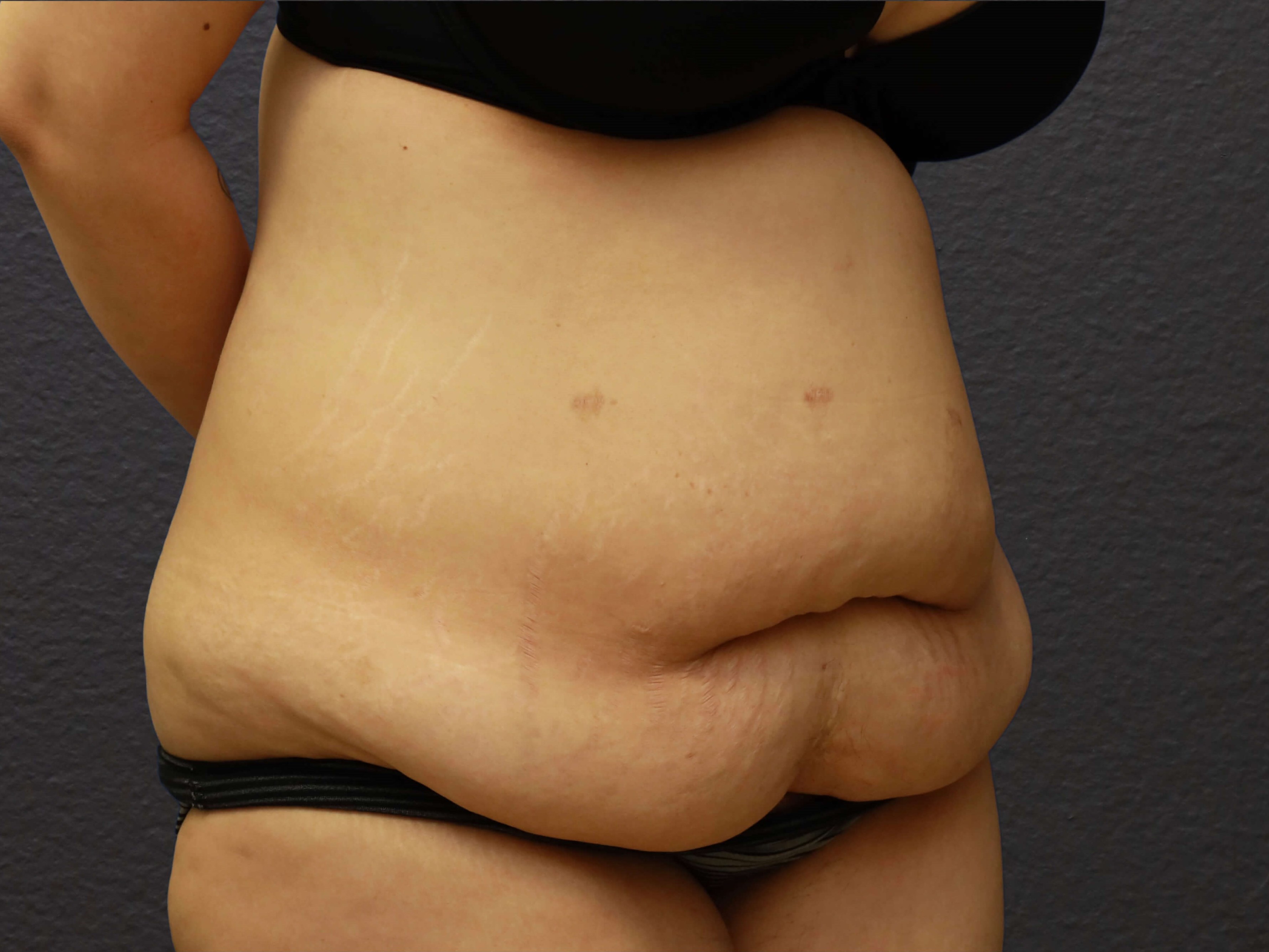 RIGHT OBLIQUE Before