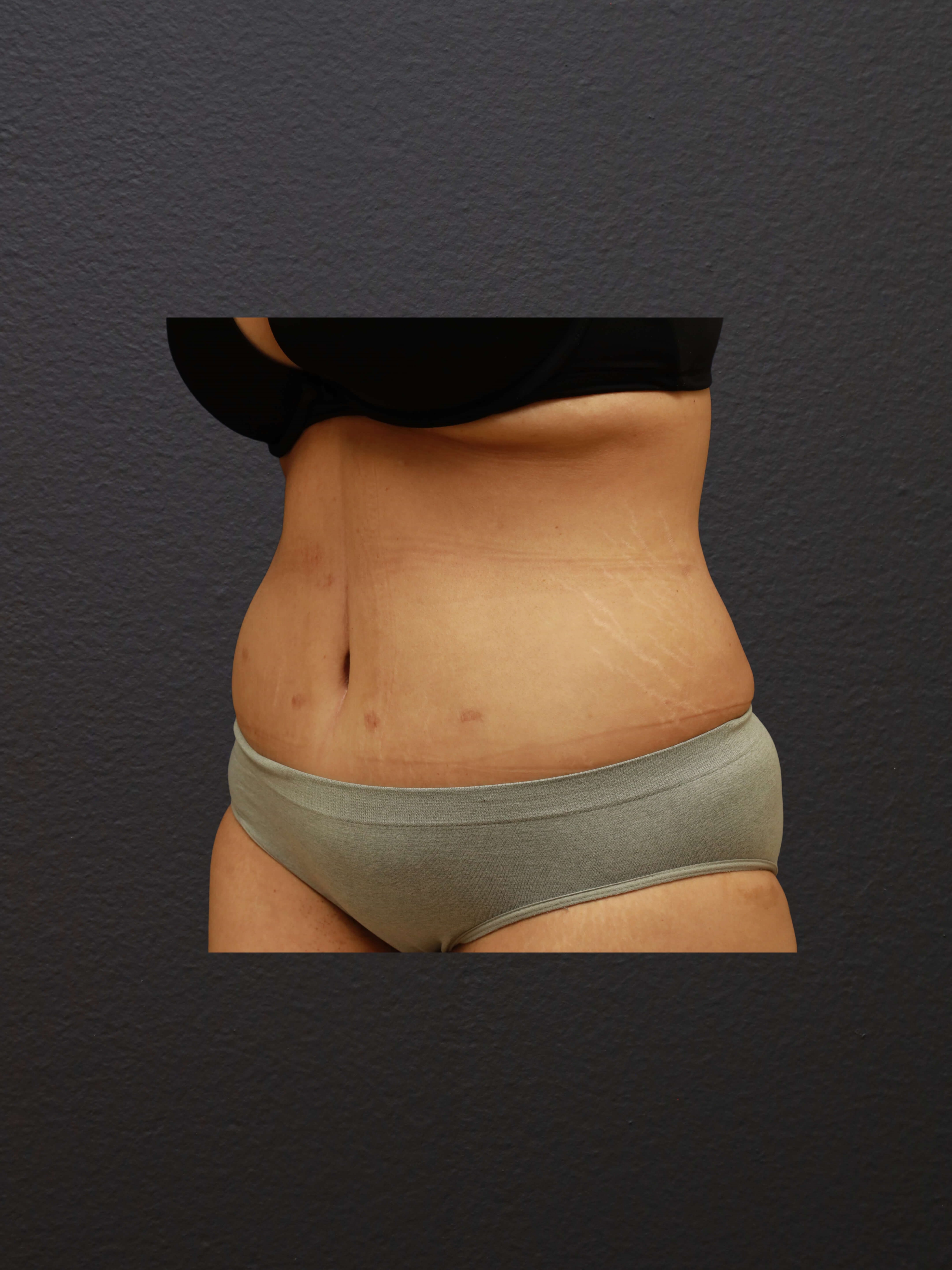 LEFT OBLIQUE After