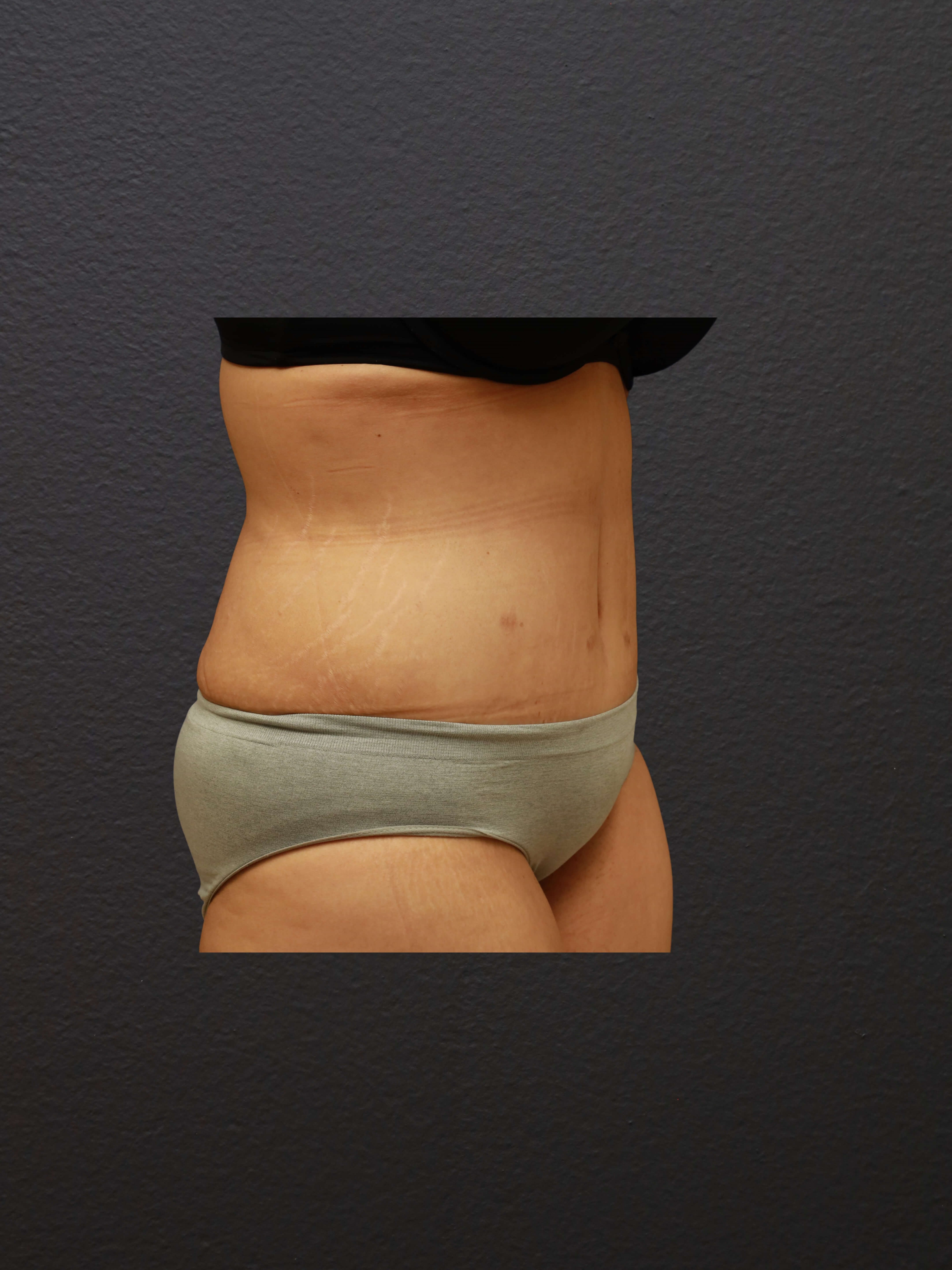 RIGHT OBLIQUE After