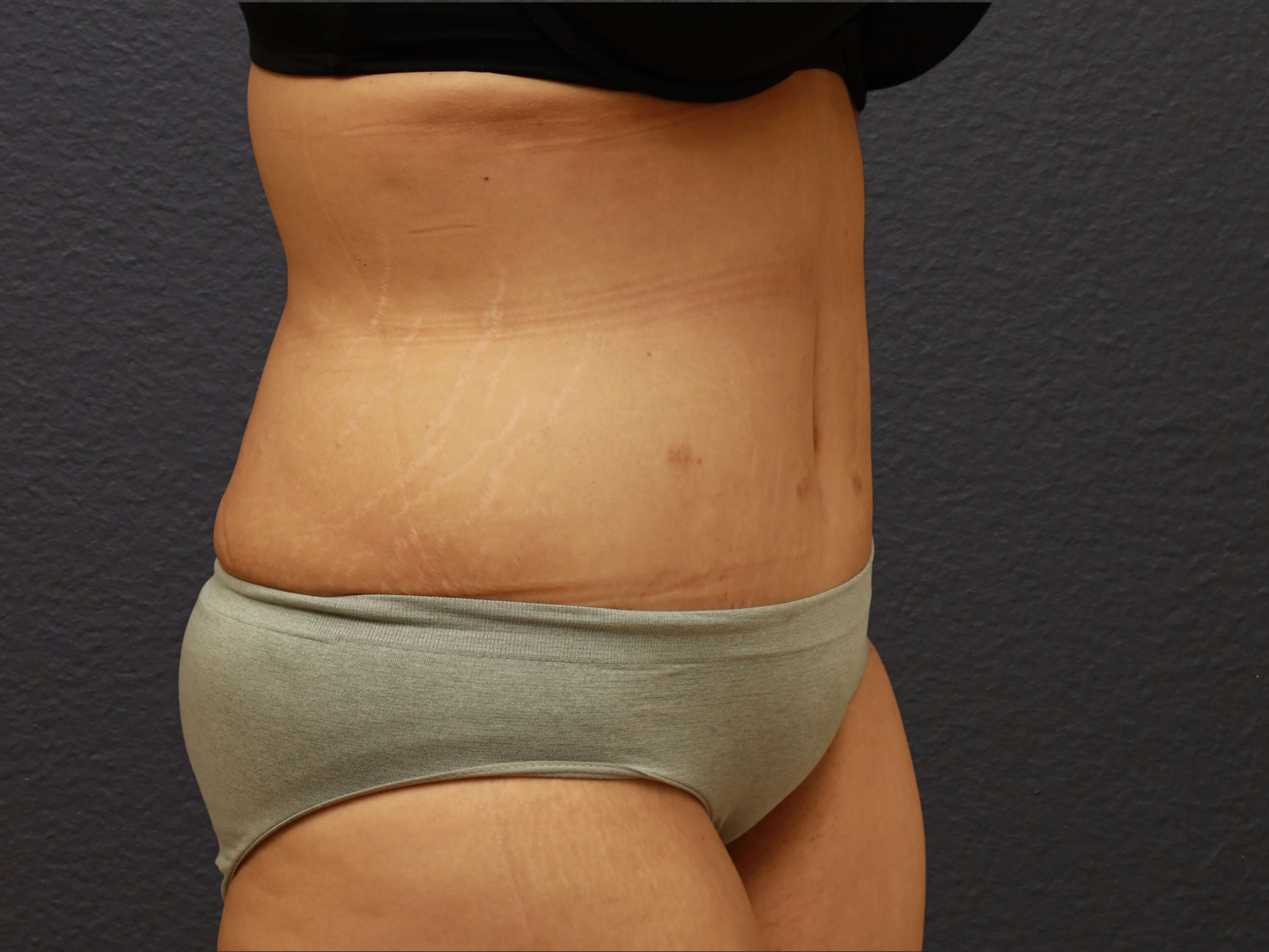RIGHT OBLIQUE After