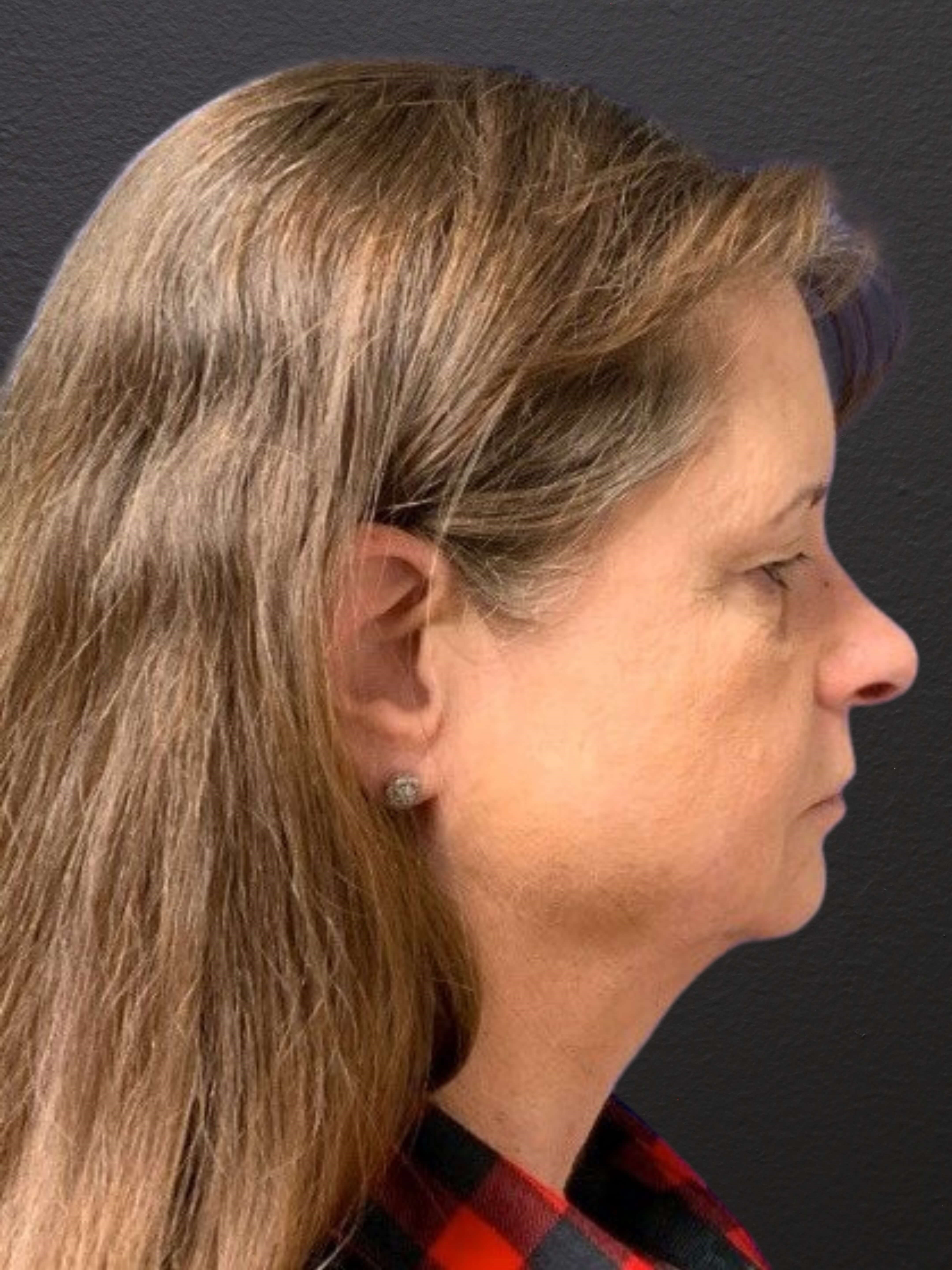 RIGHT LATERAL Before