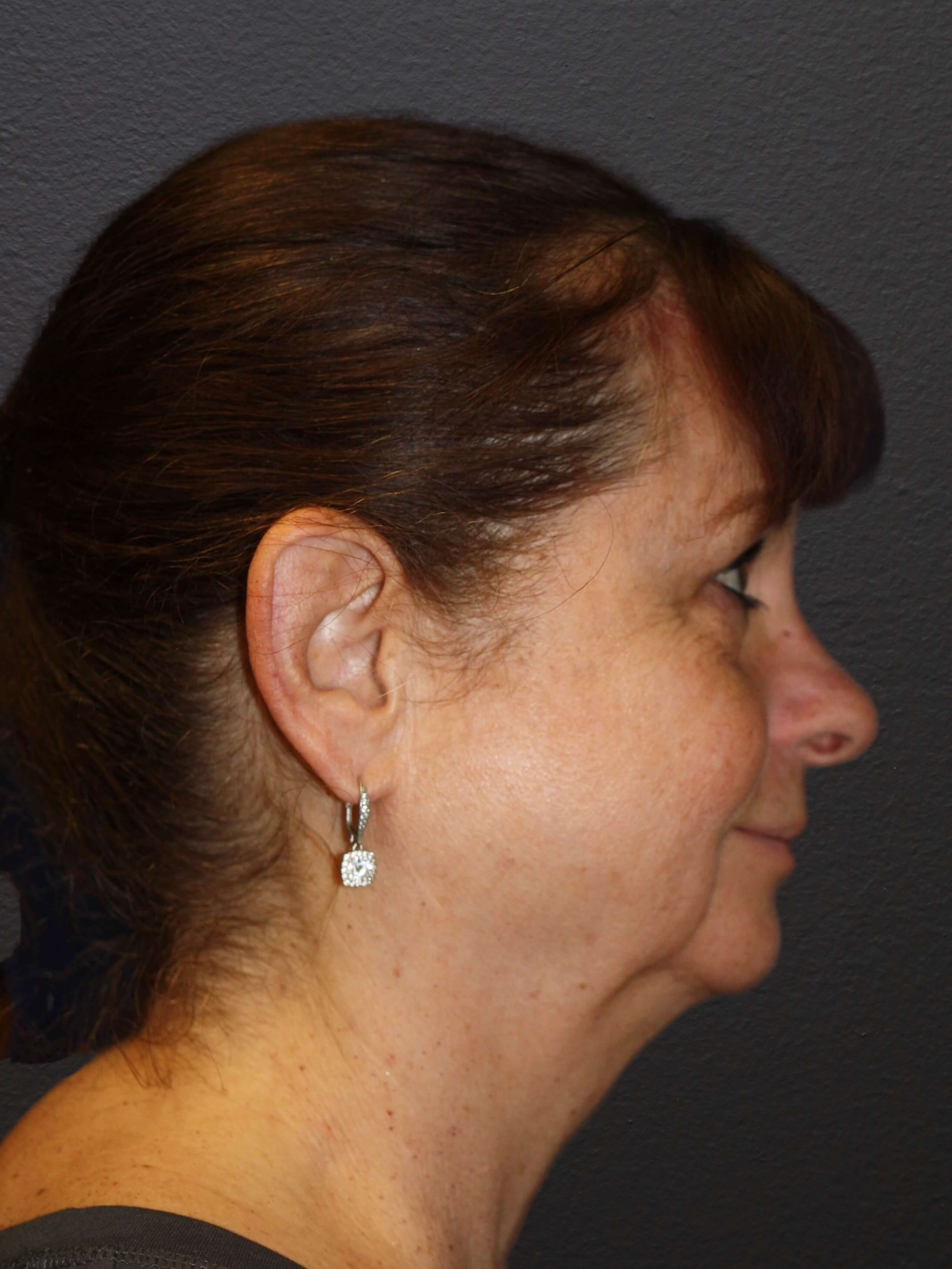 RIGHT LATERAL After