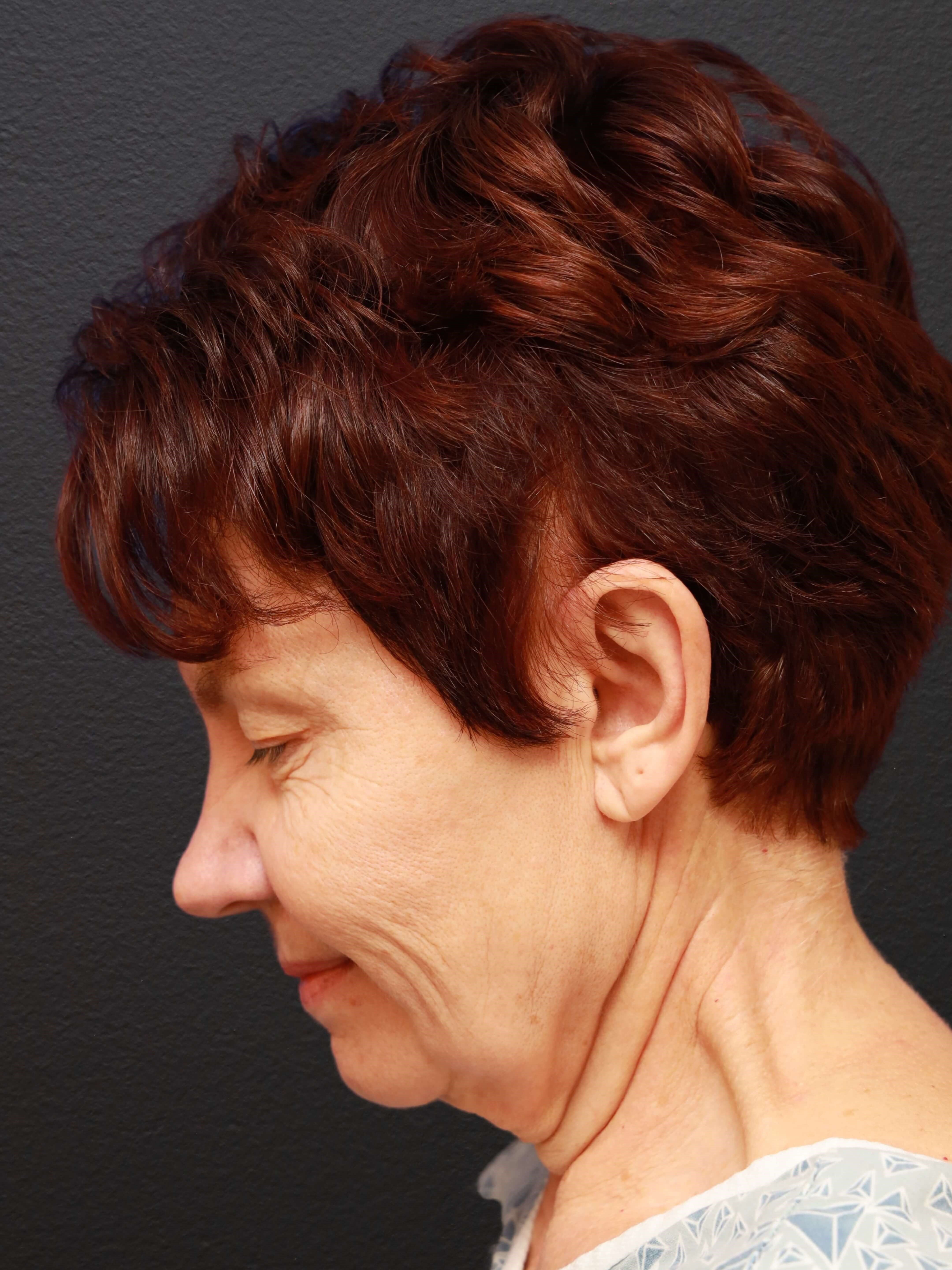 LEFT LATERAL FLEXED Before
