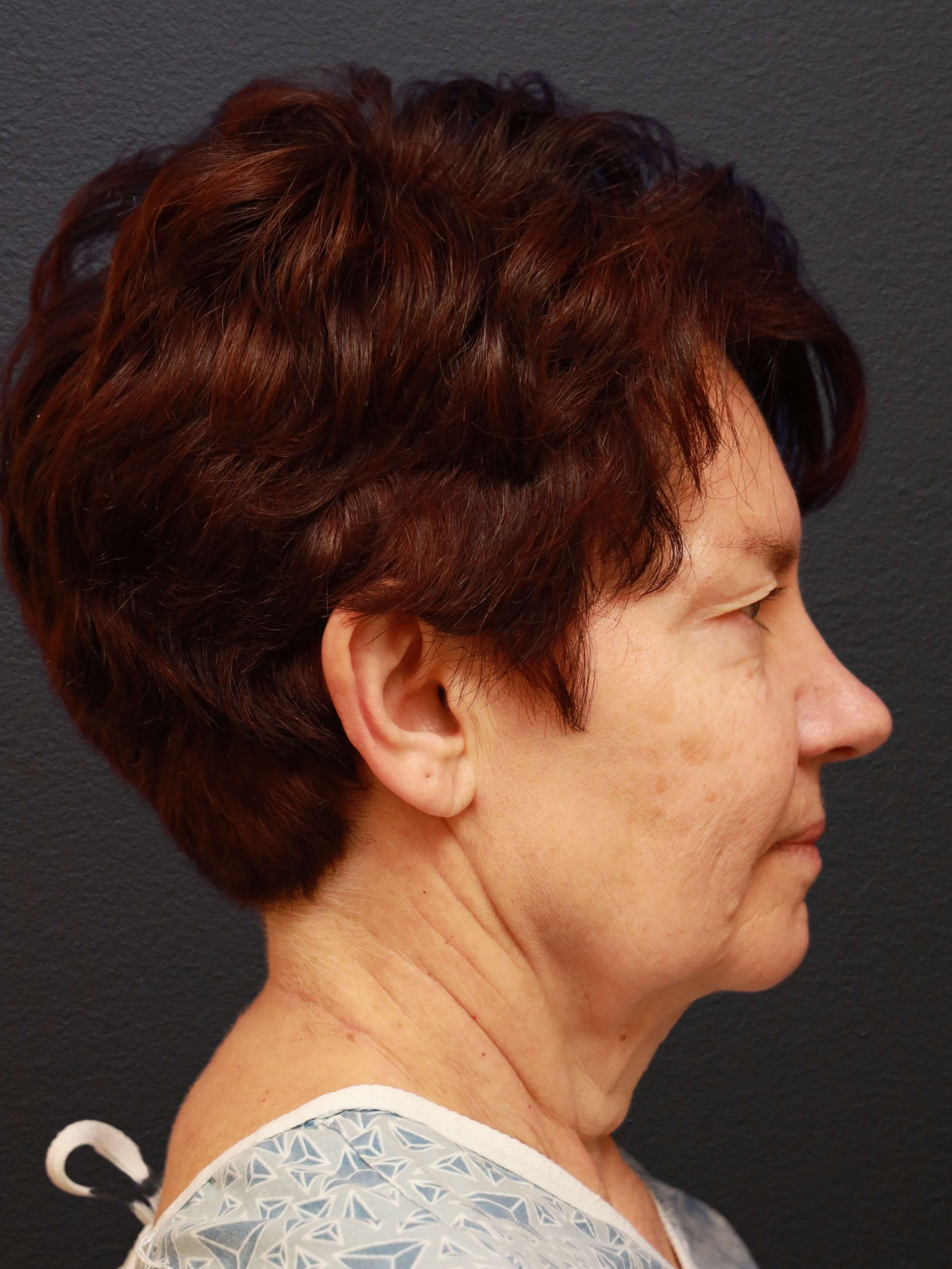 RIGHT LATERAL Before
