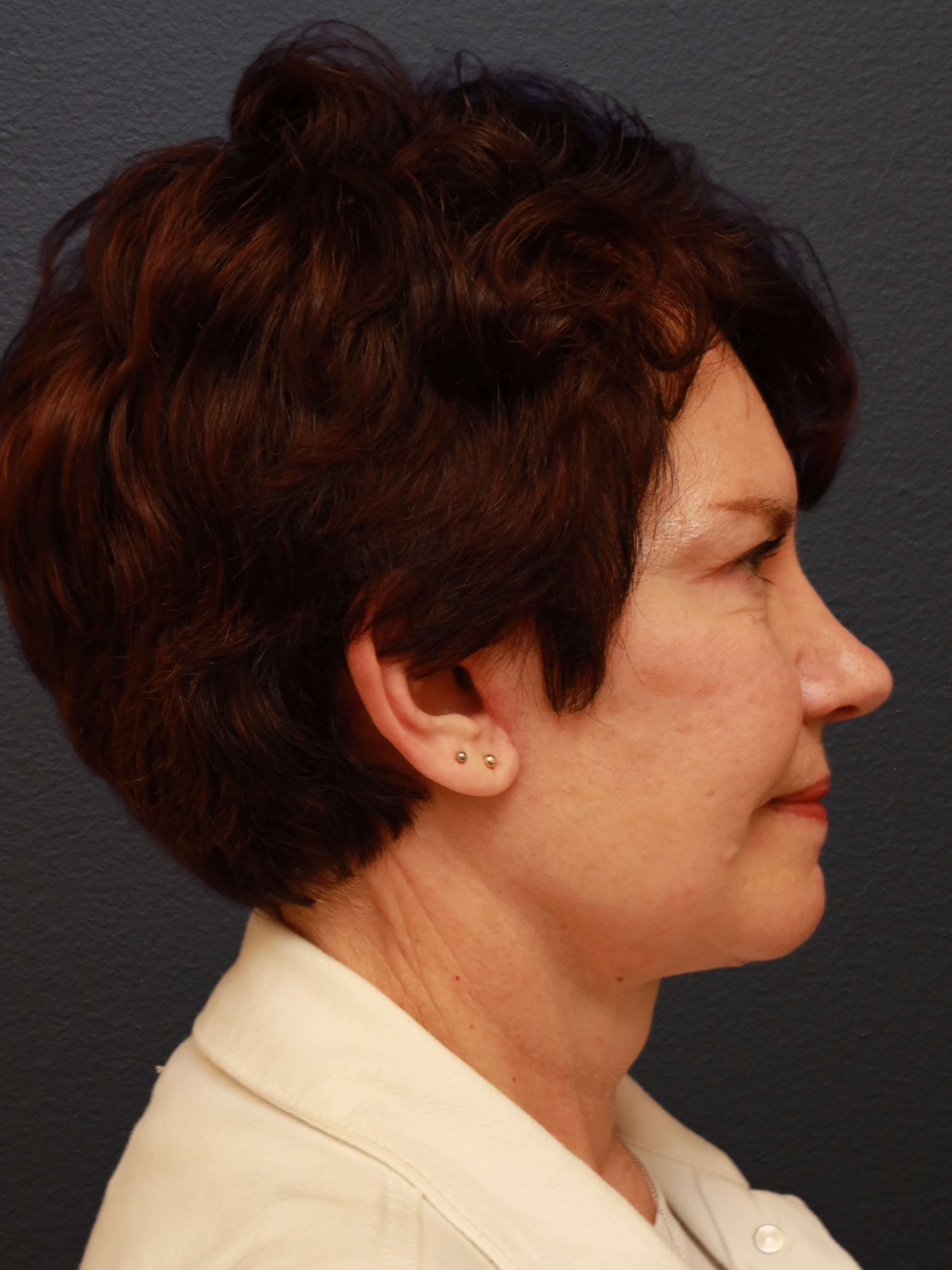 RIGHT LATERAL After