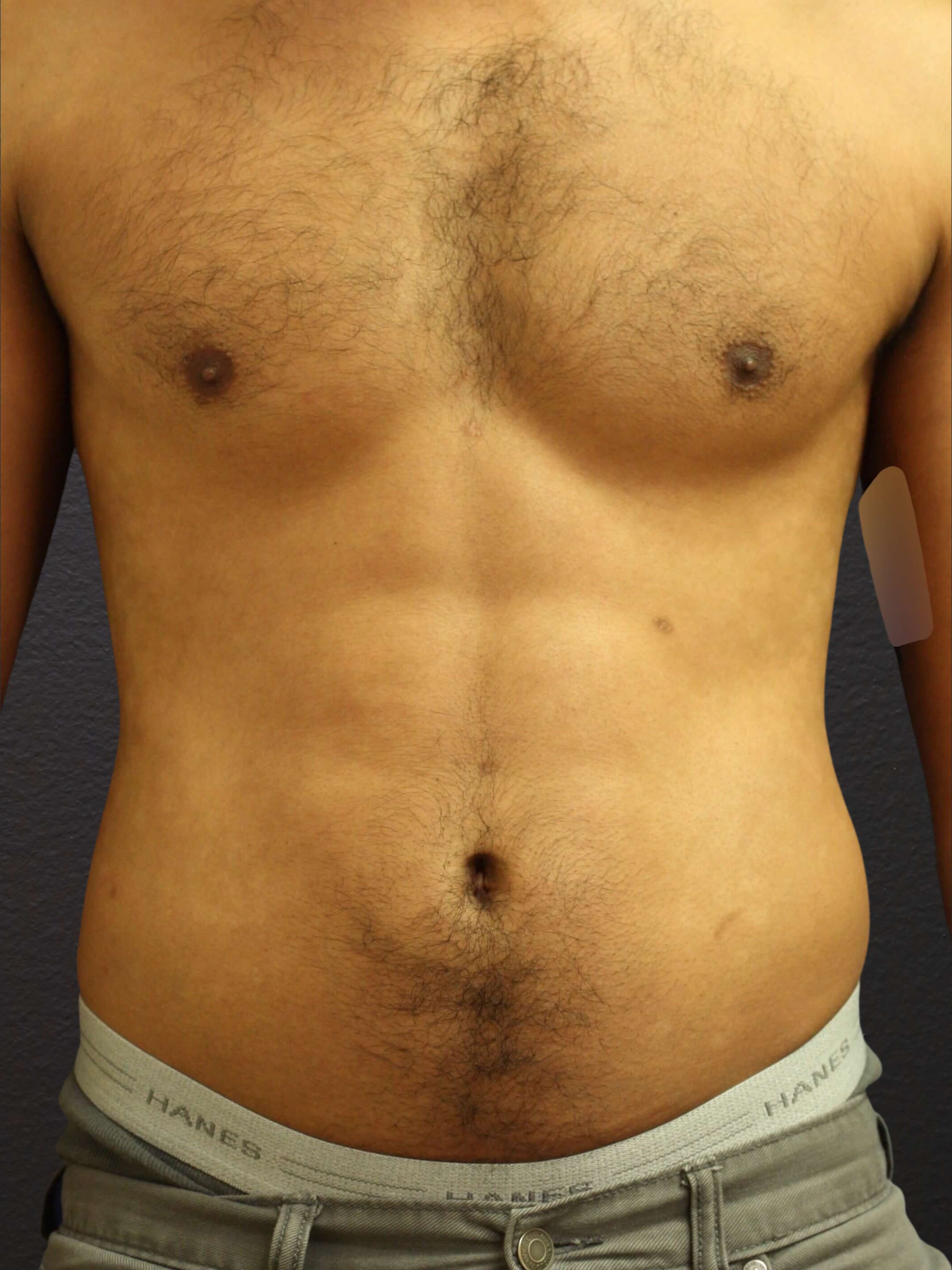 ANTERIOR After