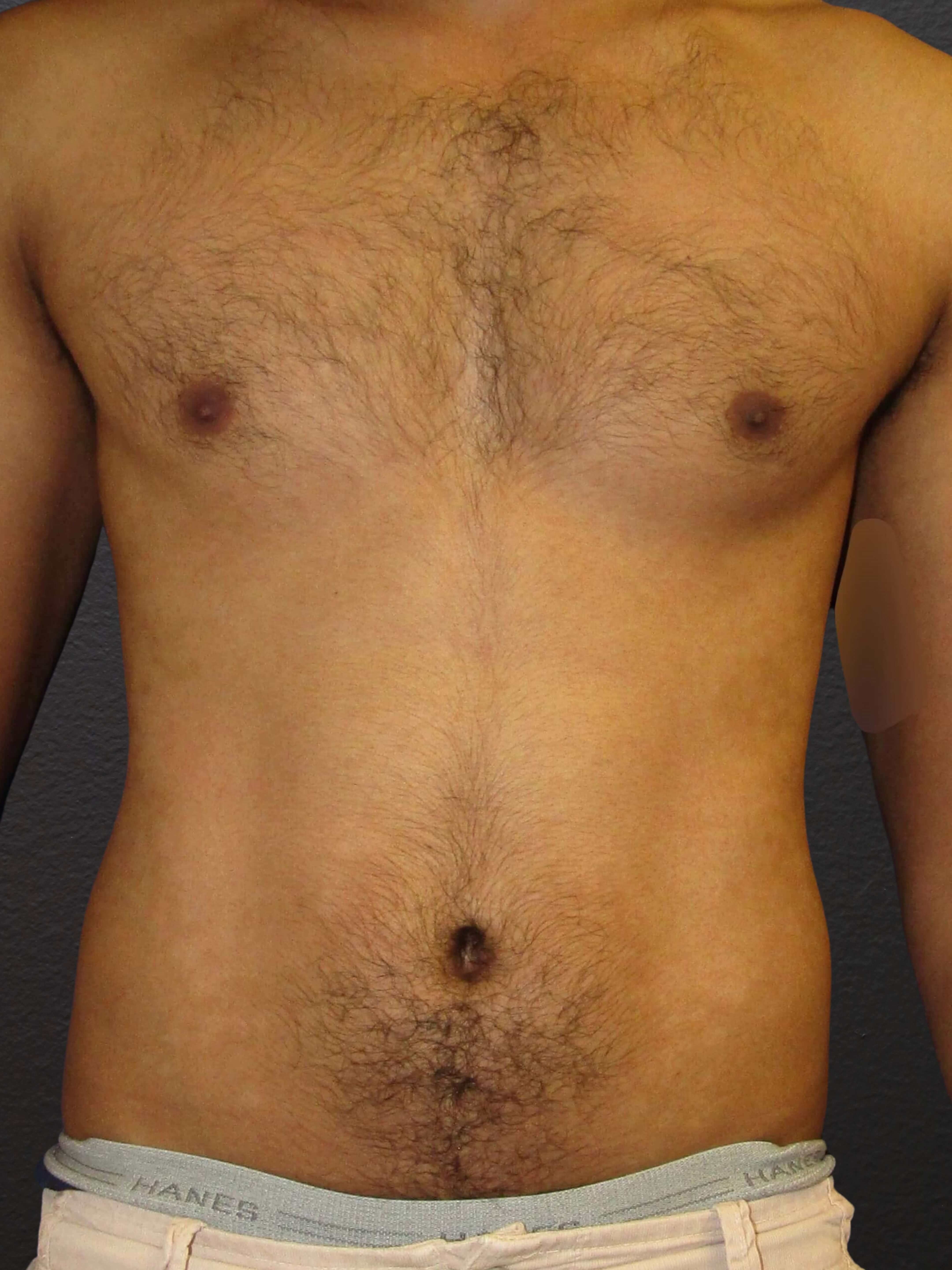ANTERIOR Before