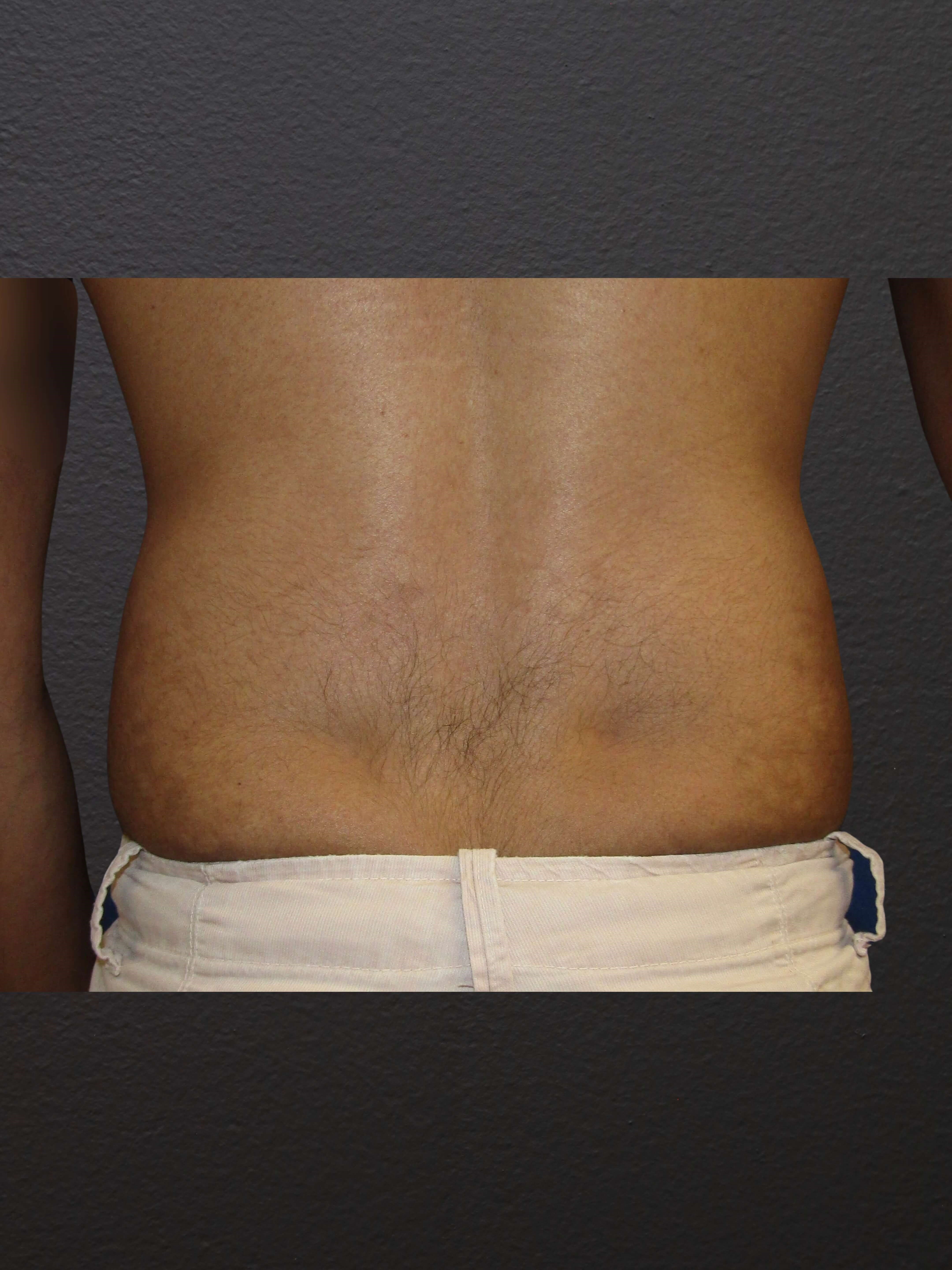 POSTERIOR Before