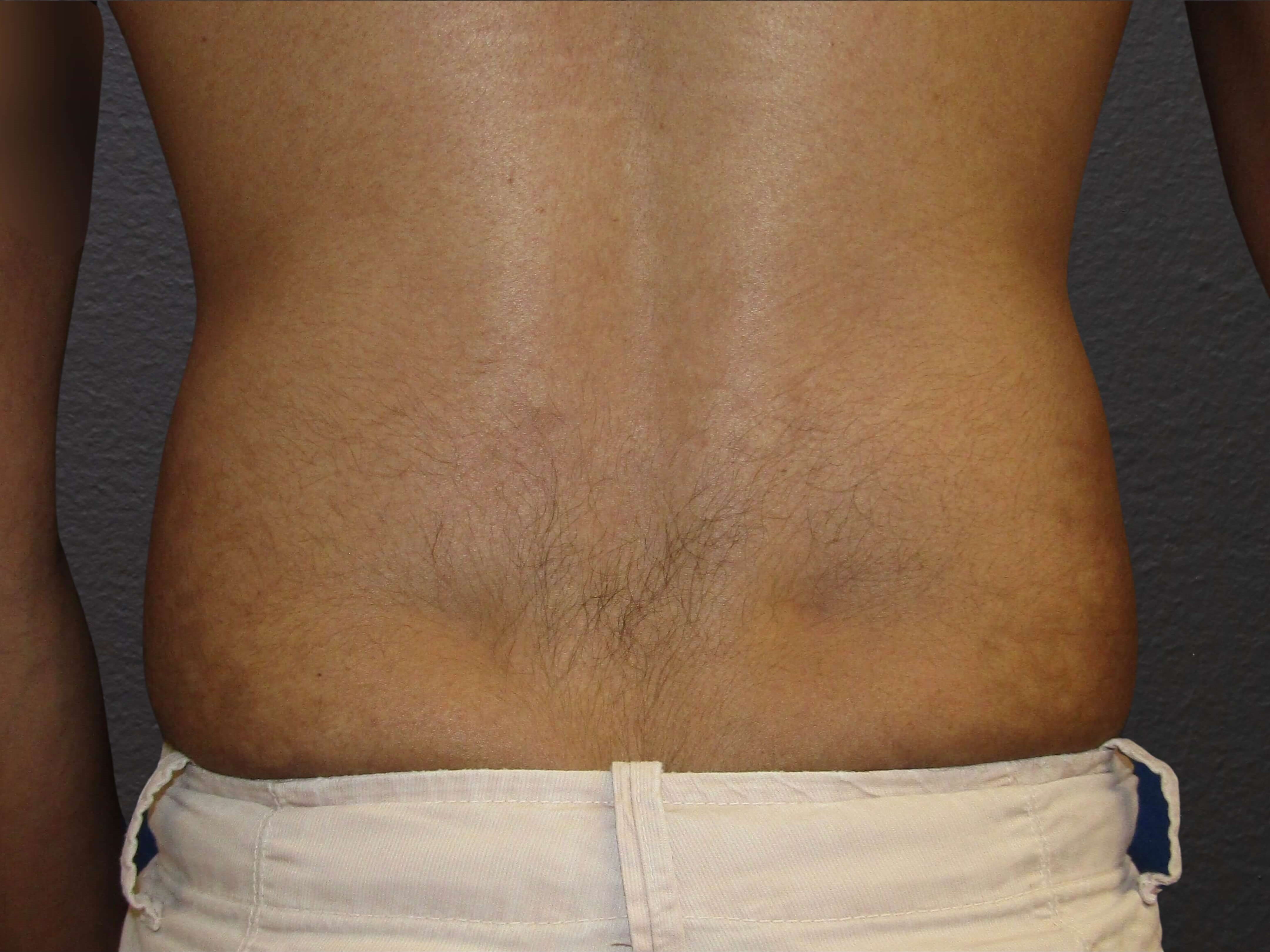 POSTERIOR Before
