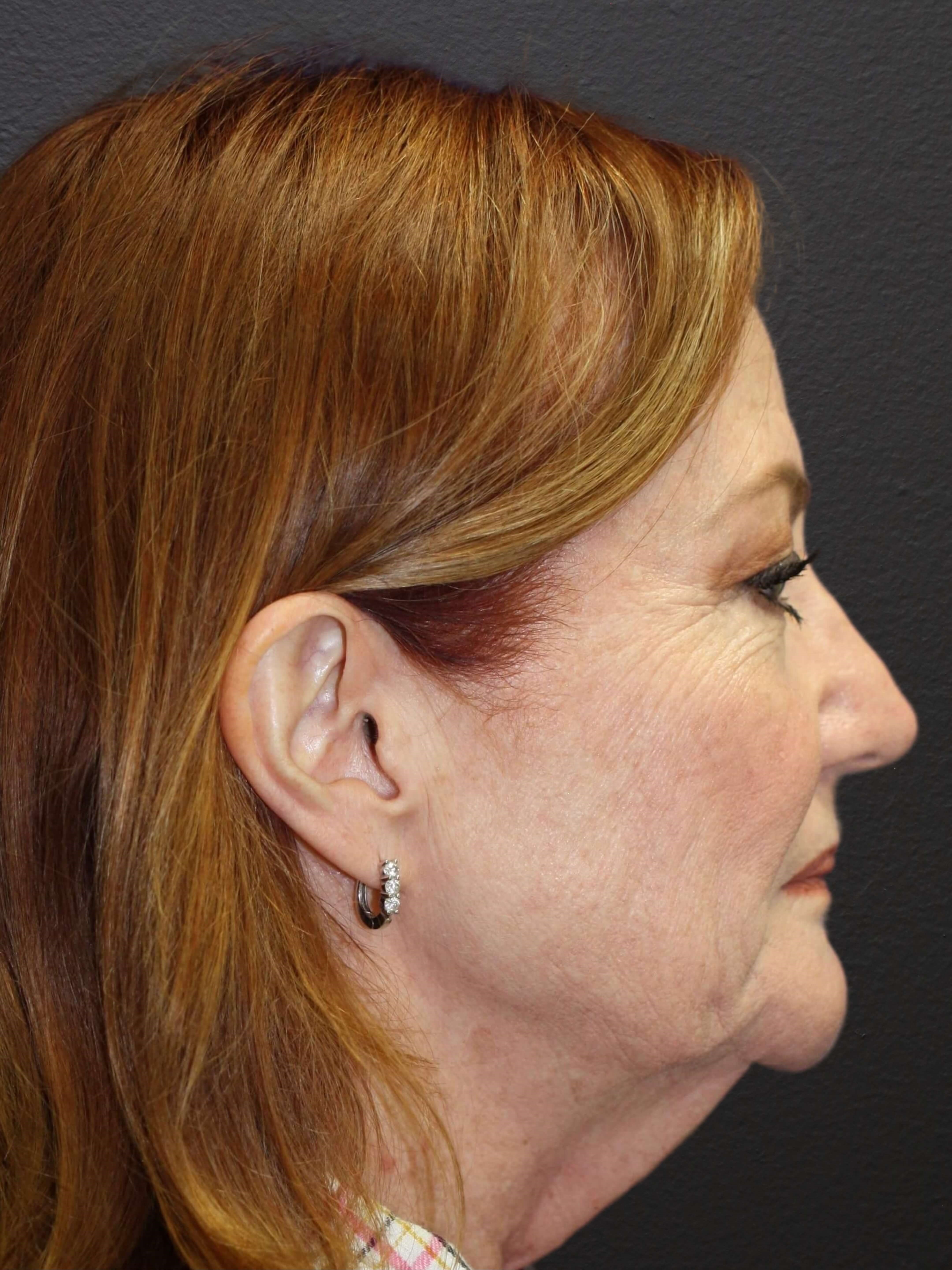 RIGHT LATERAL Before