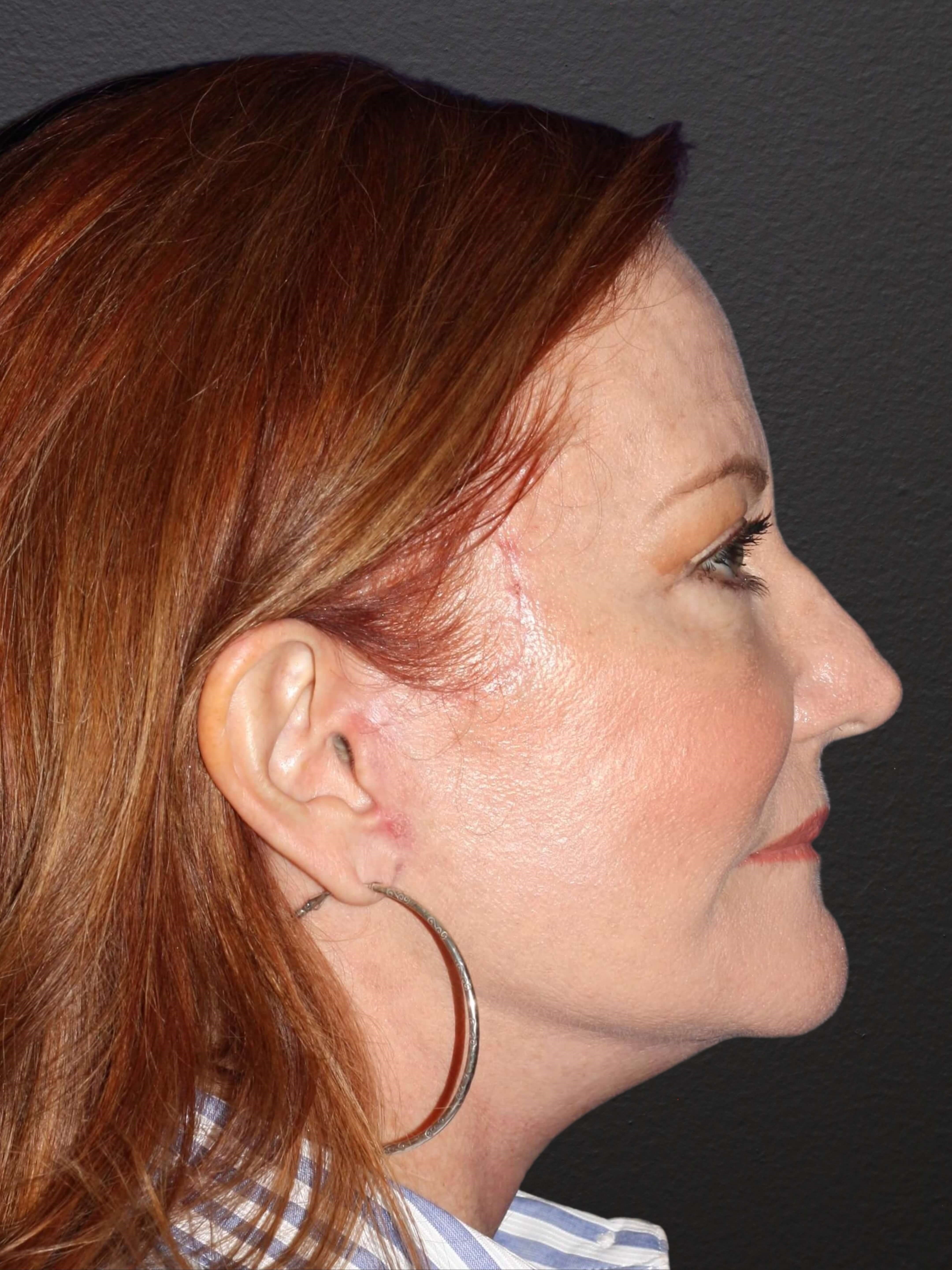RIGHT LATERAL After