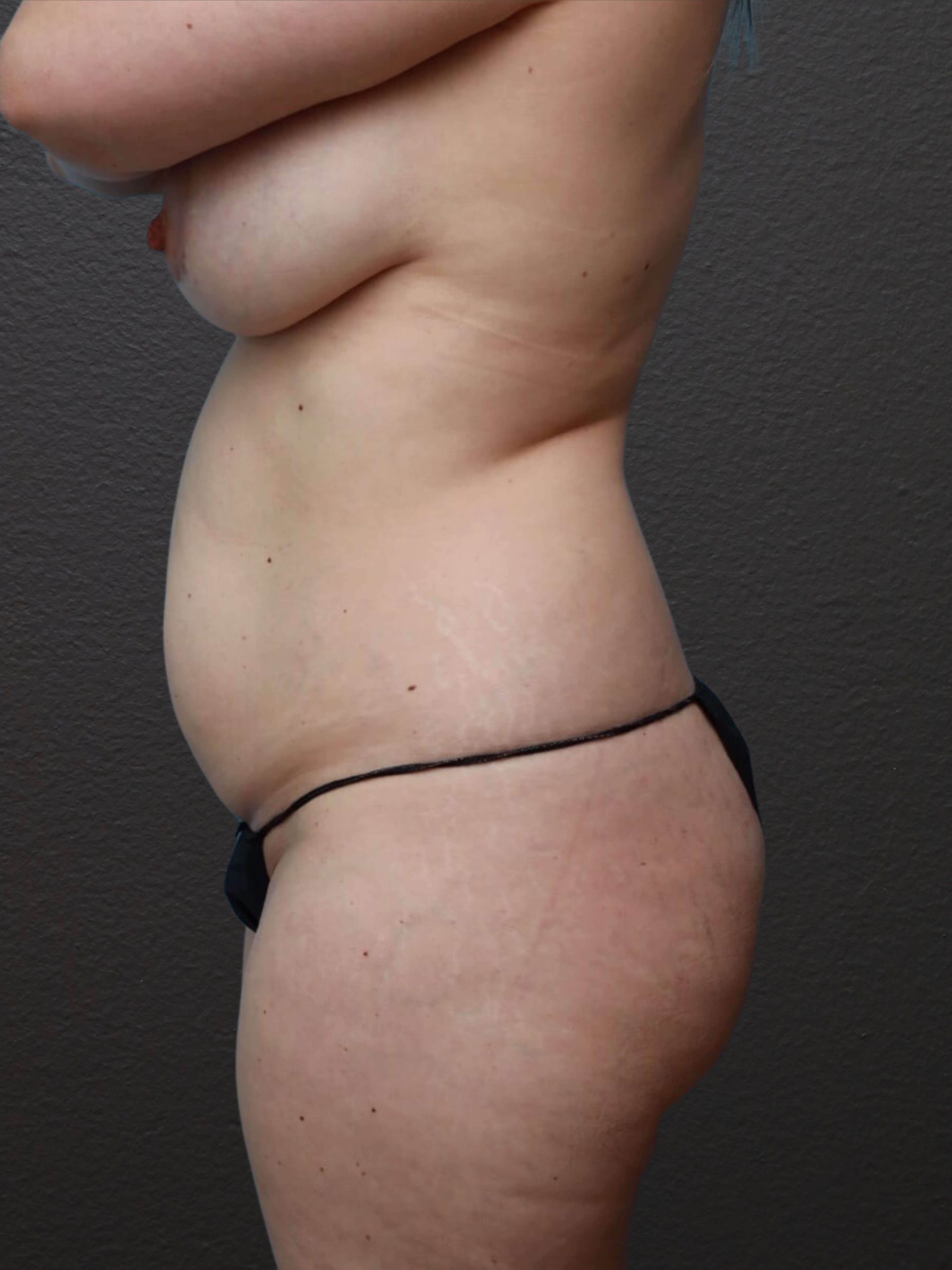 Left Lateral Before