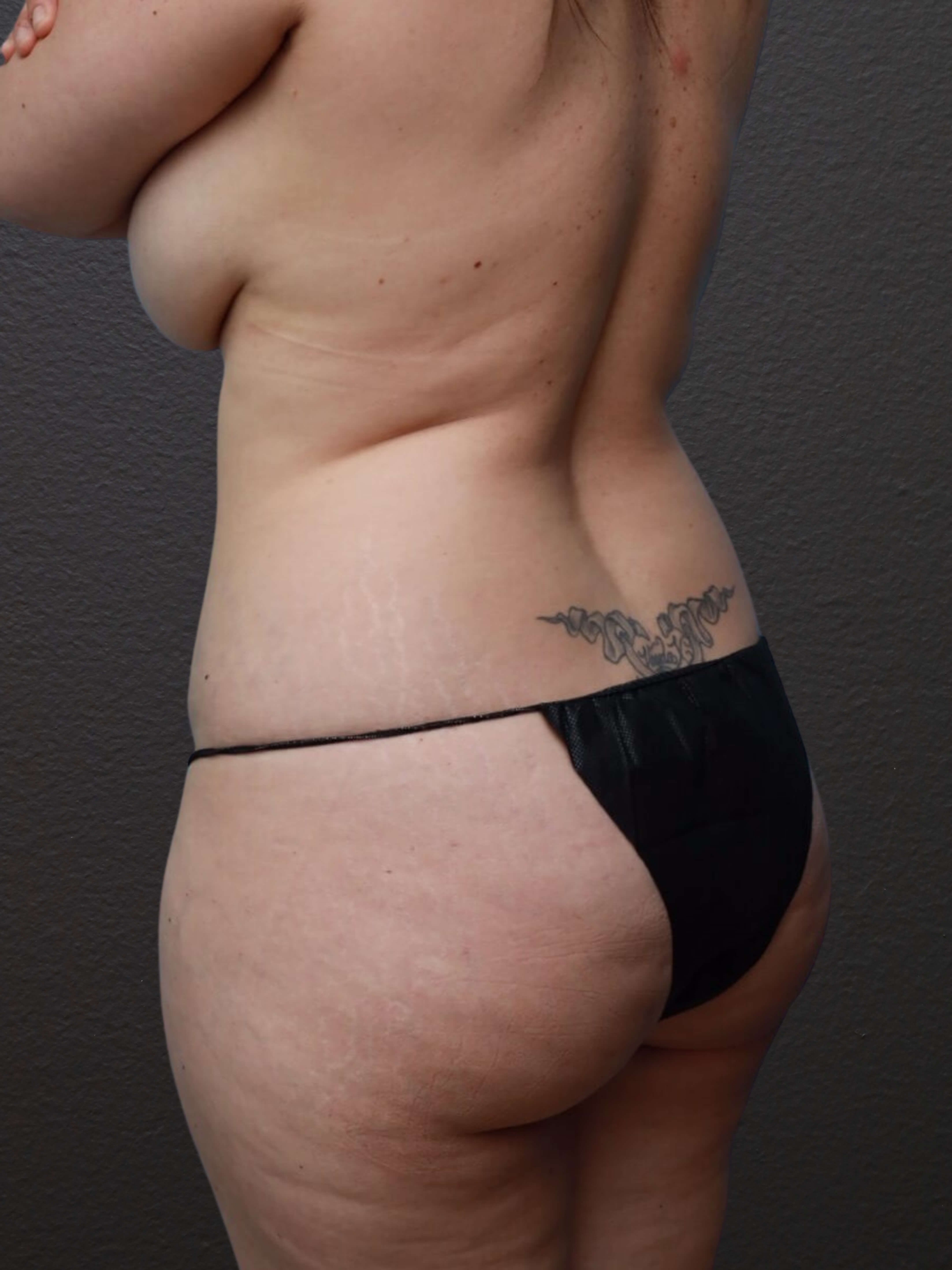 Left Oblique Before