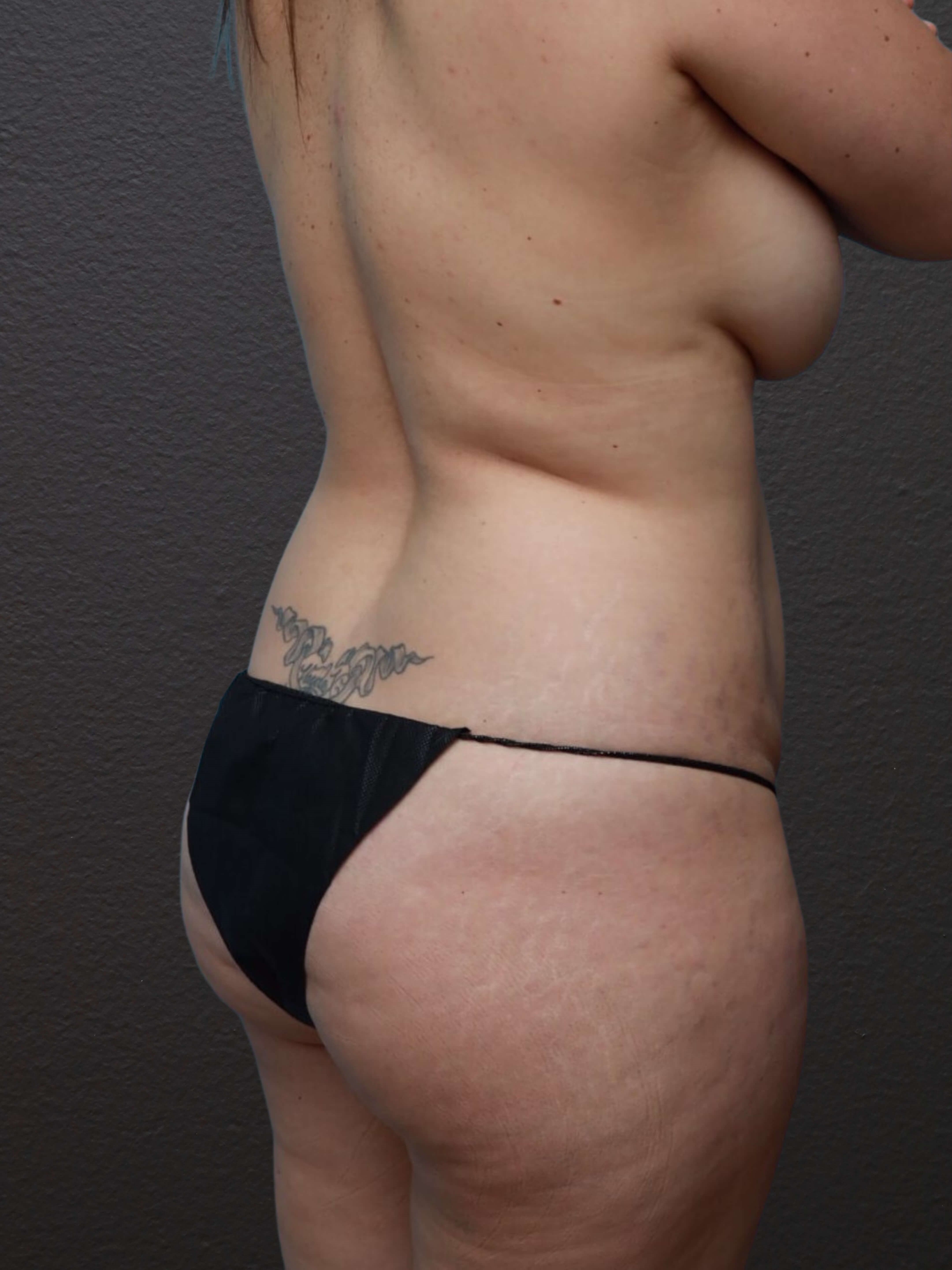 Right Oblique Before