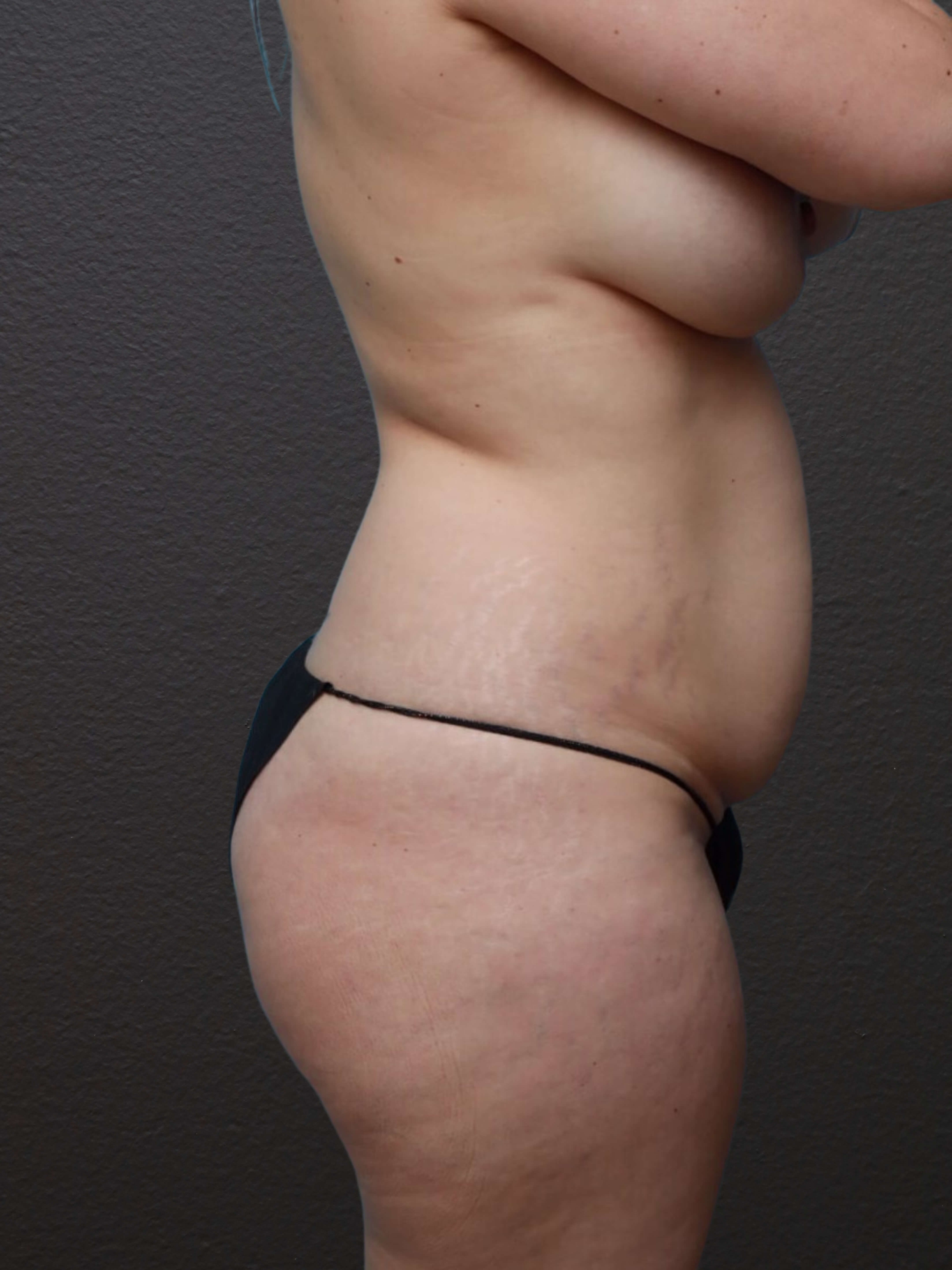 Right Lateral Before