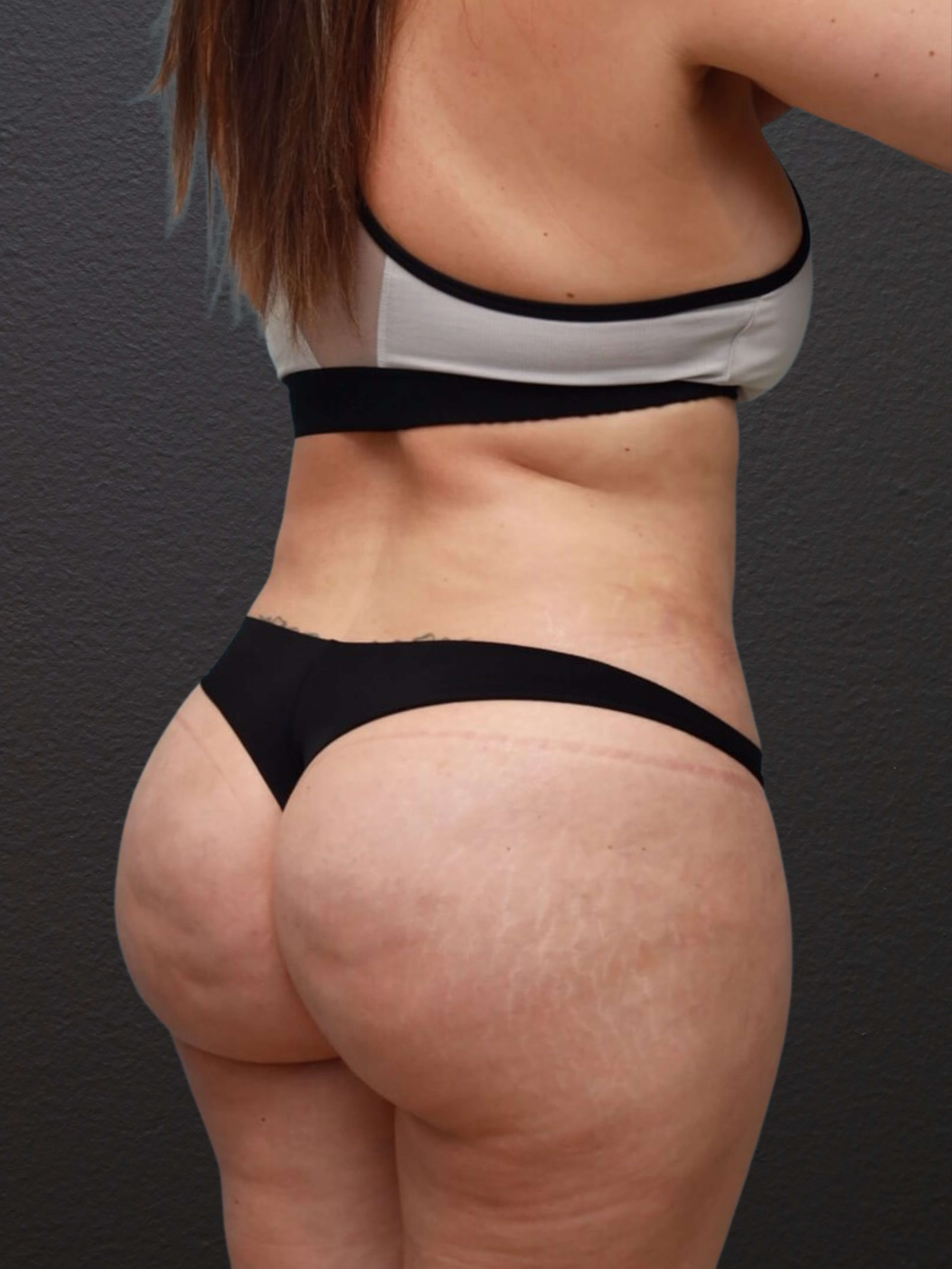 Right Oblique After