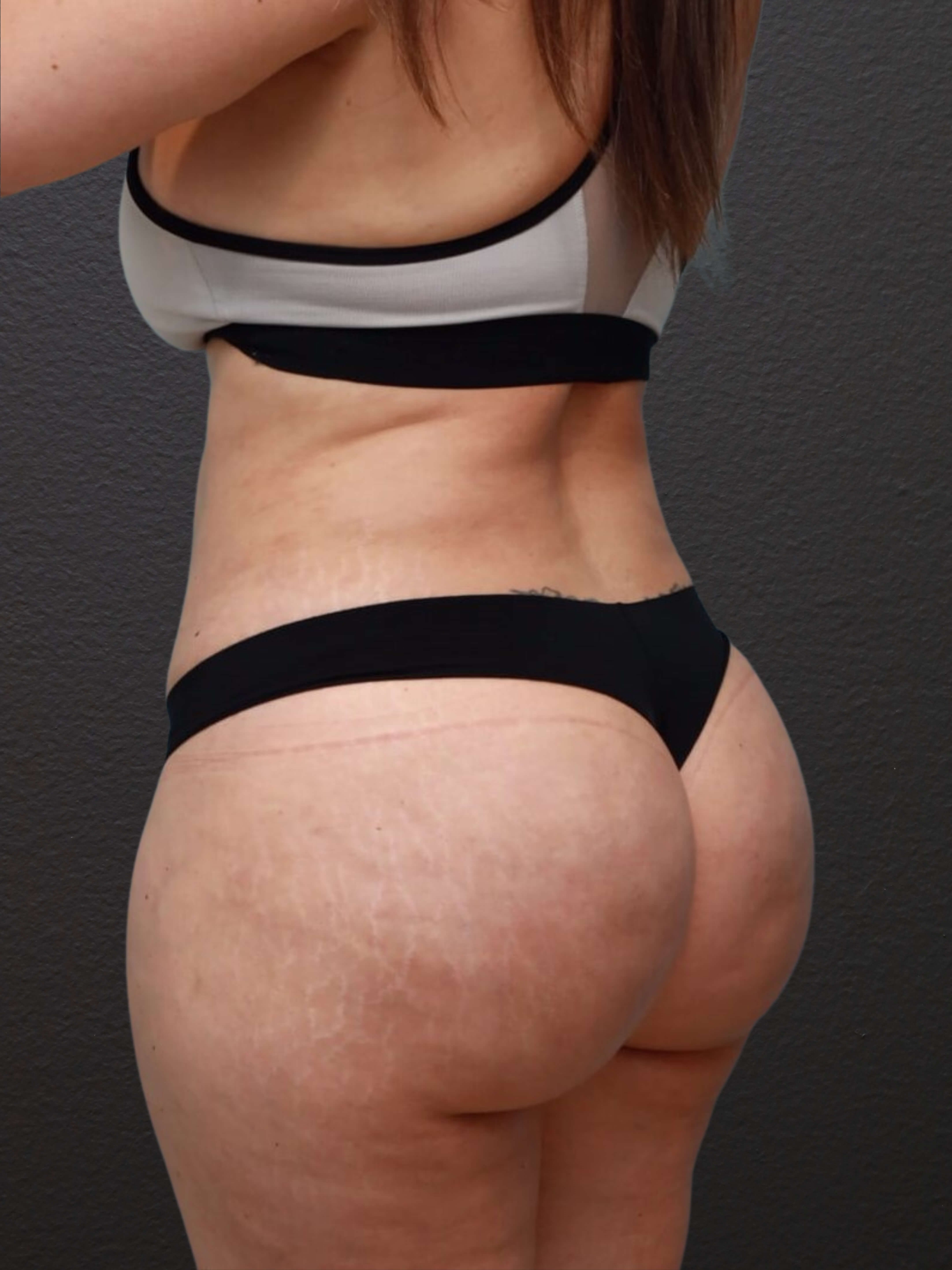 Left Oblique After