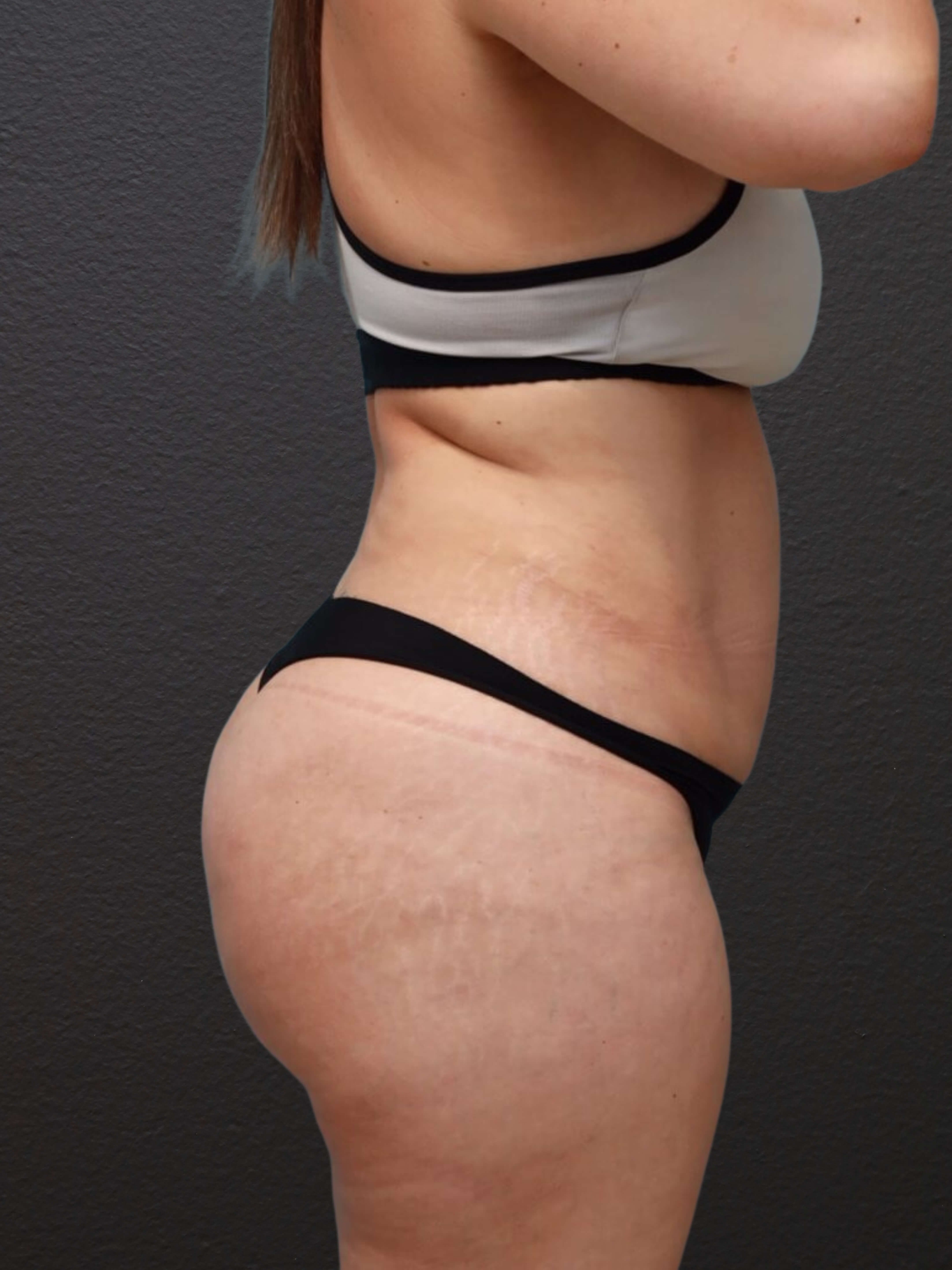 Right Lateral After