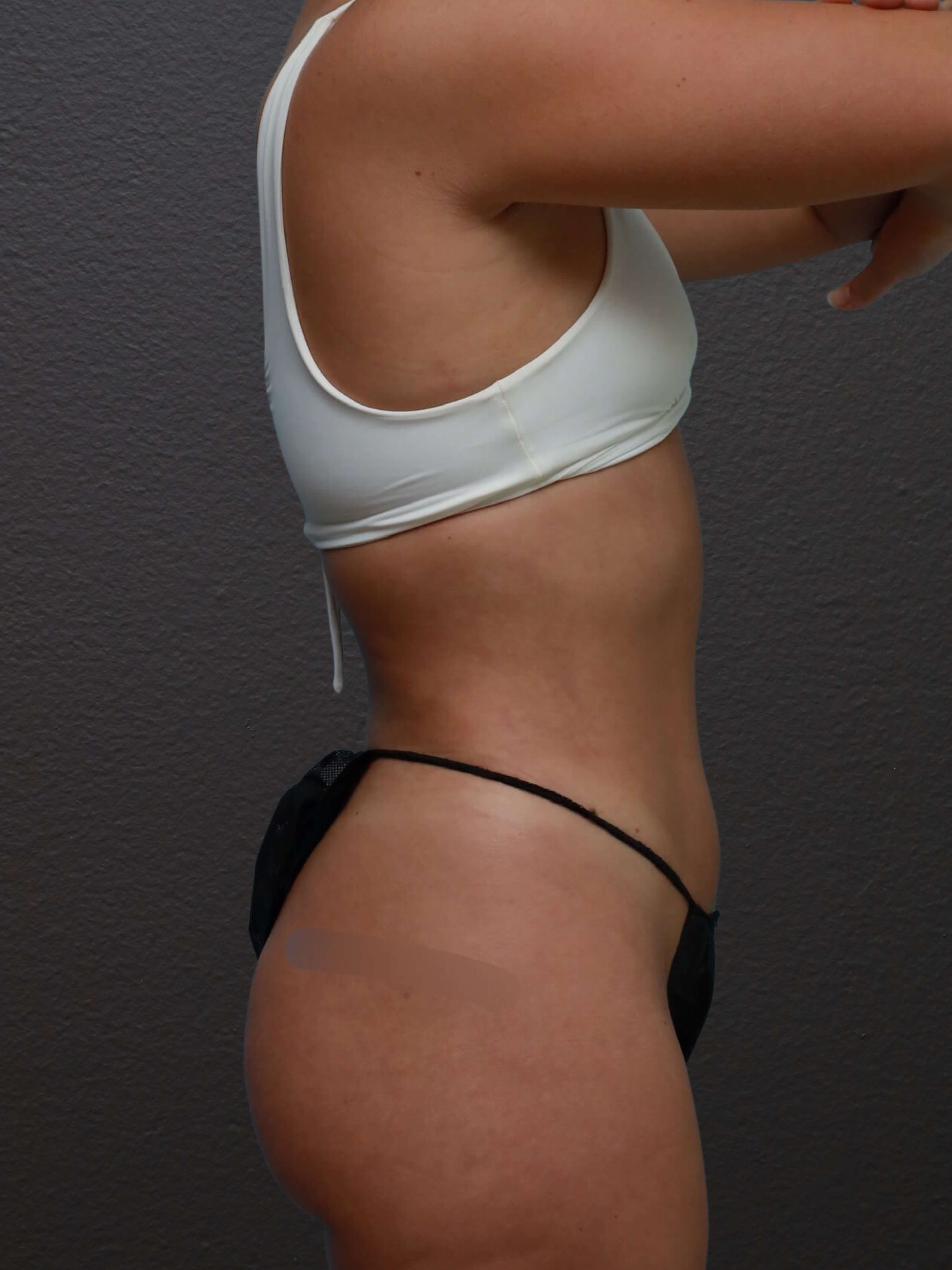 Right Lateral After