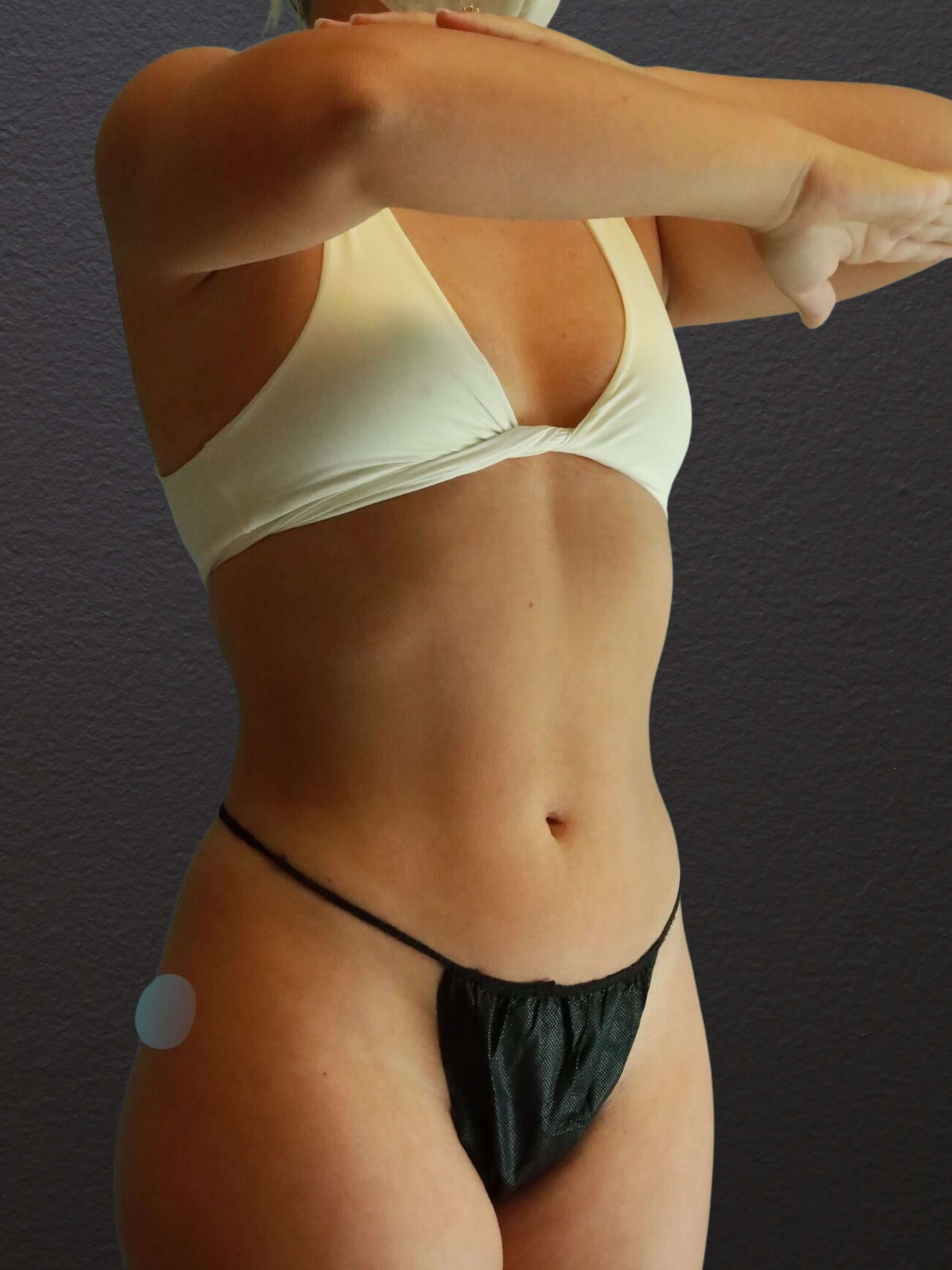 Right Oblique After