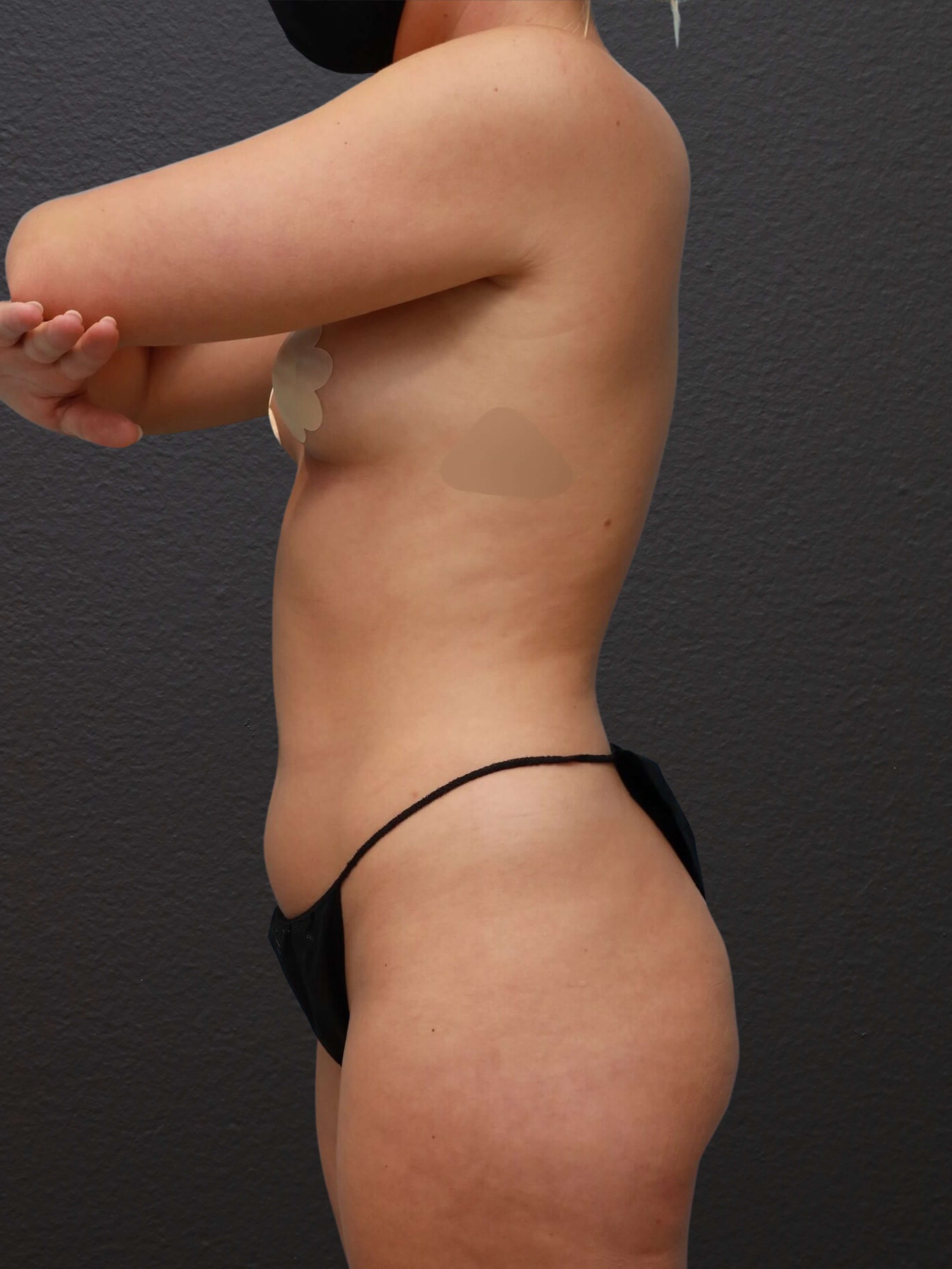 Left Lateral Before