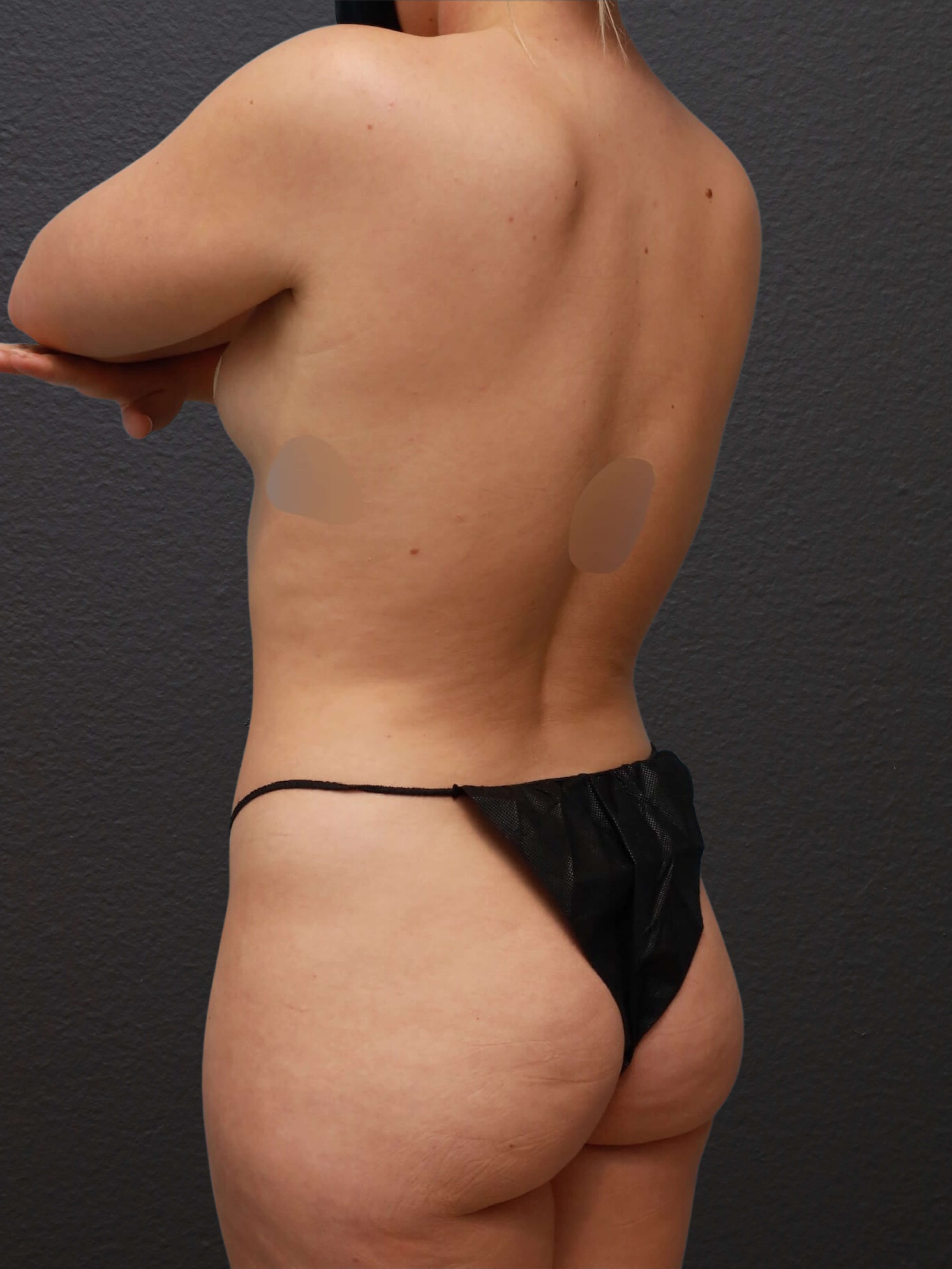 Left Posterior Oblique Before