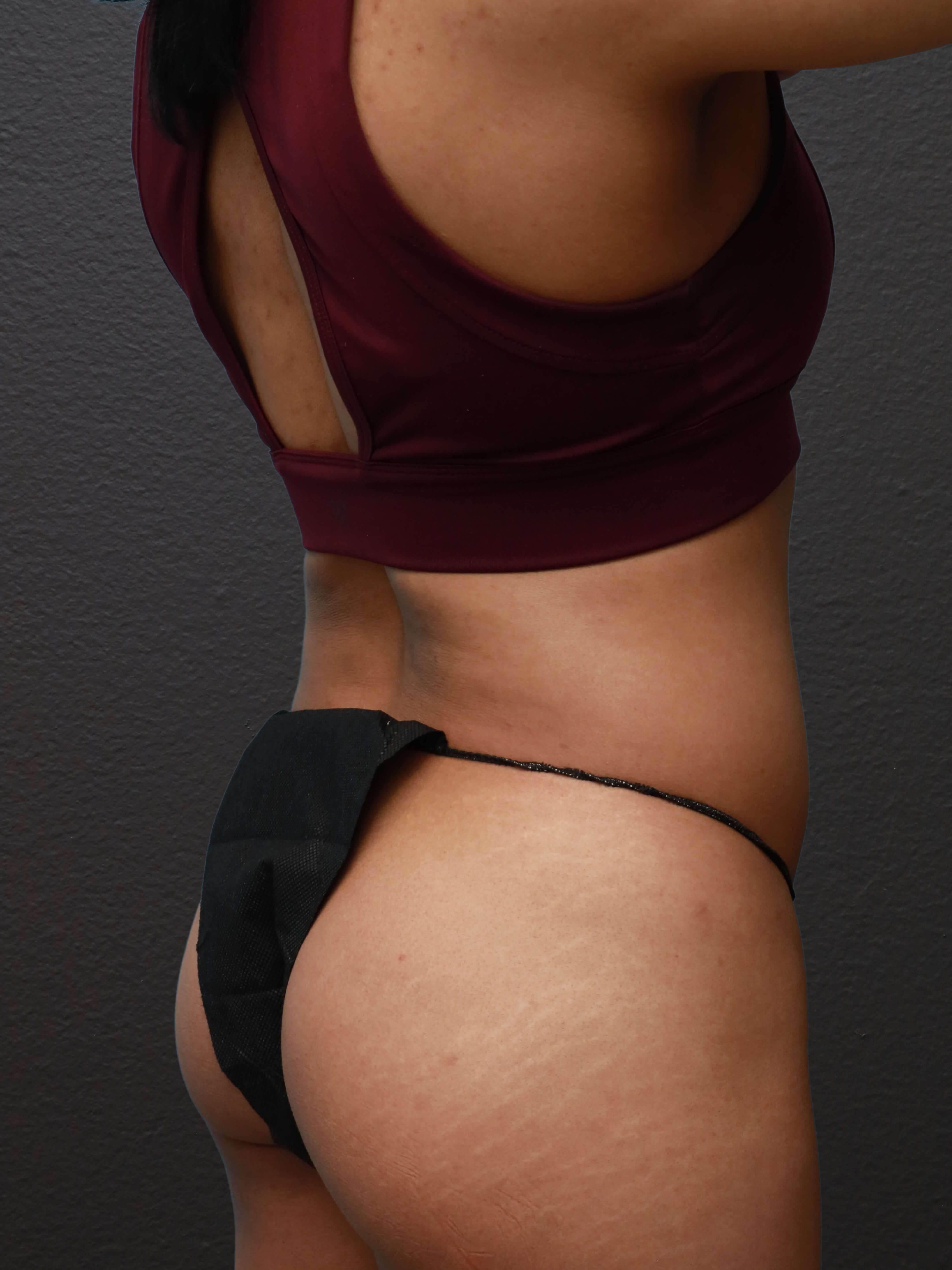 Right Back Oblique Before