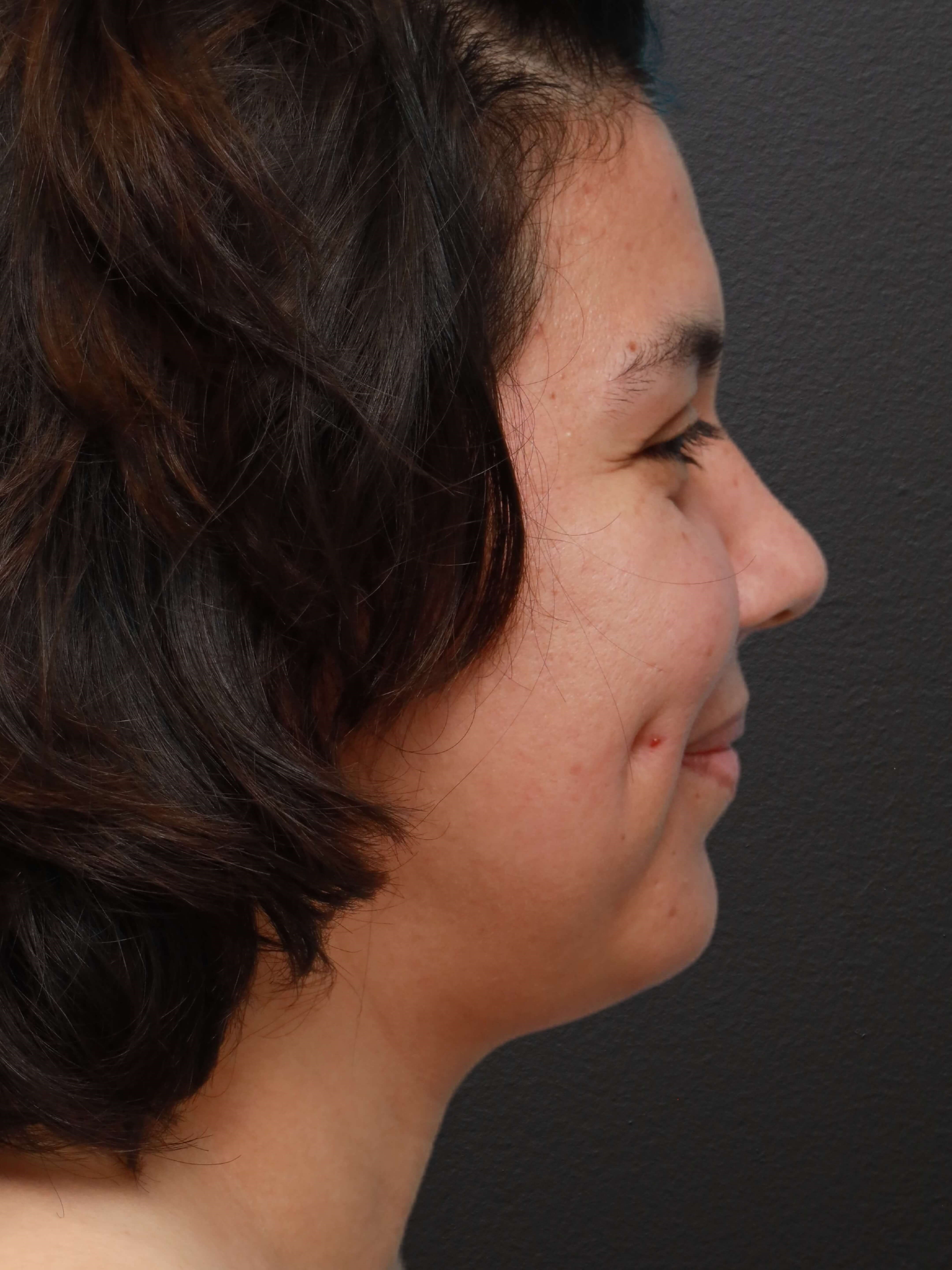 Right Lateral Before