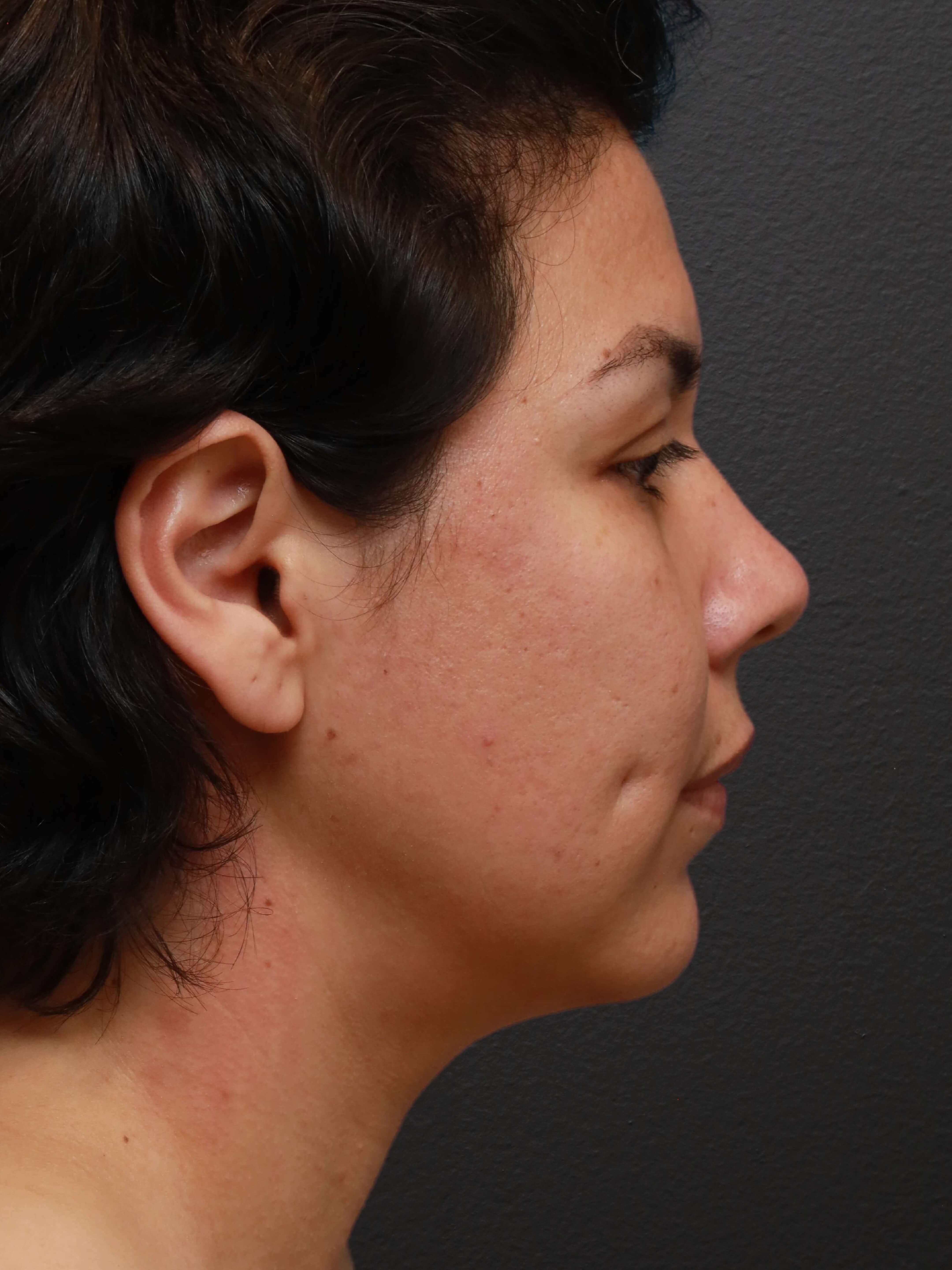 Right Lateral After