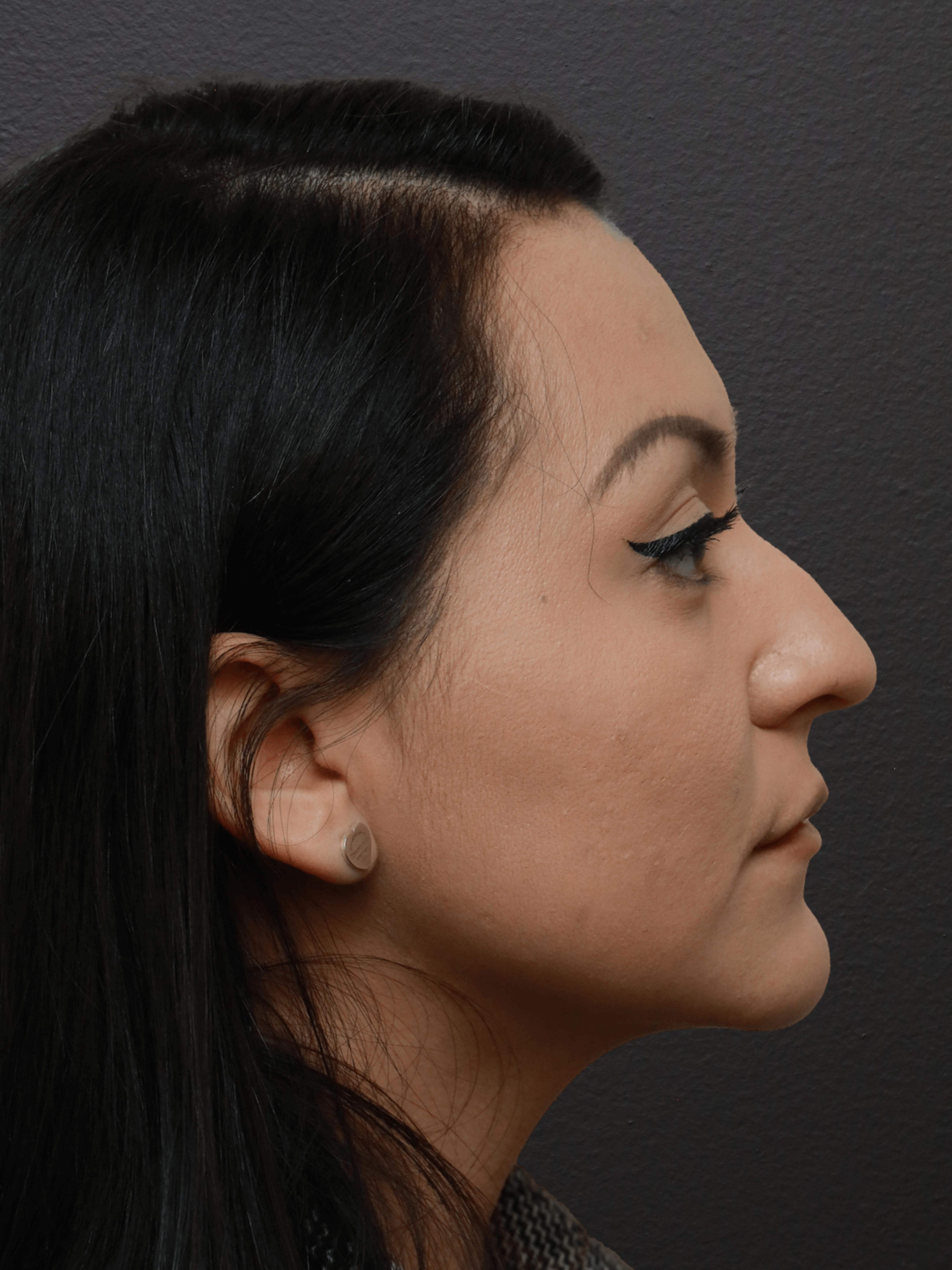 Right Lateral Before