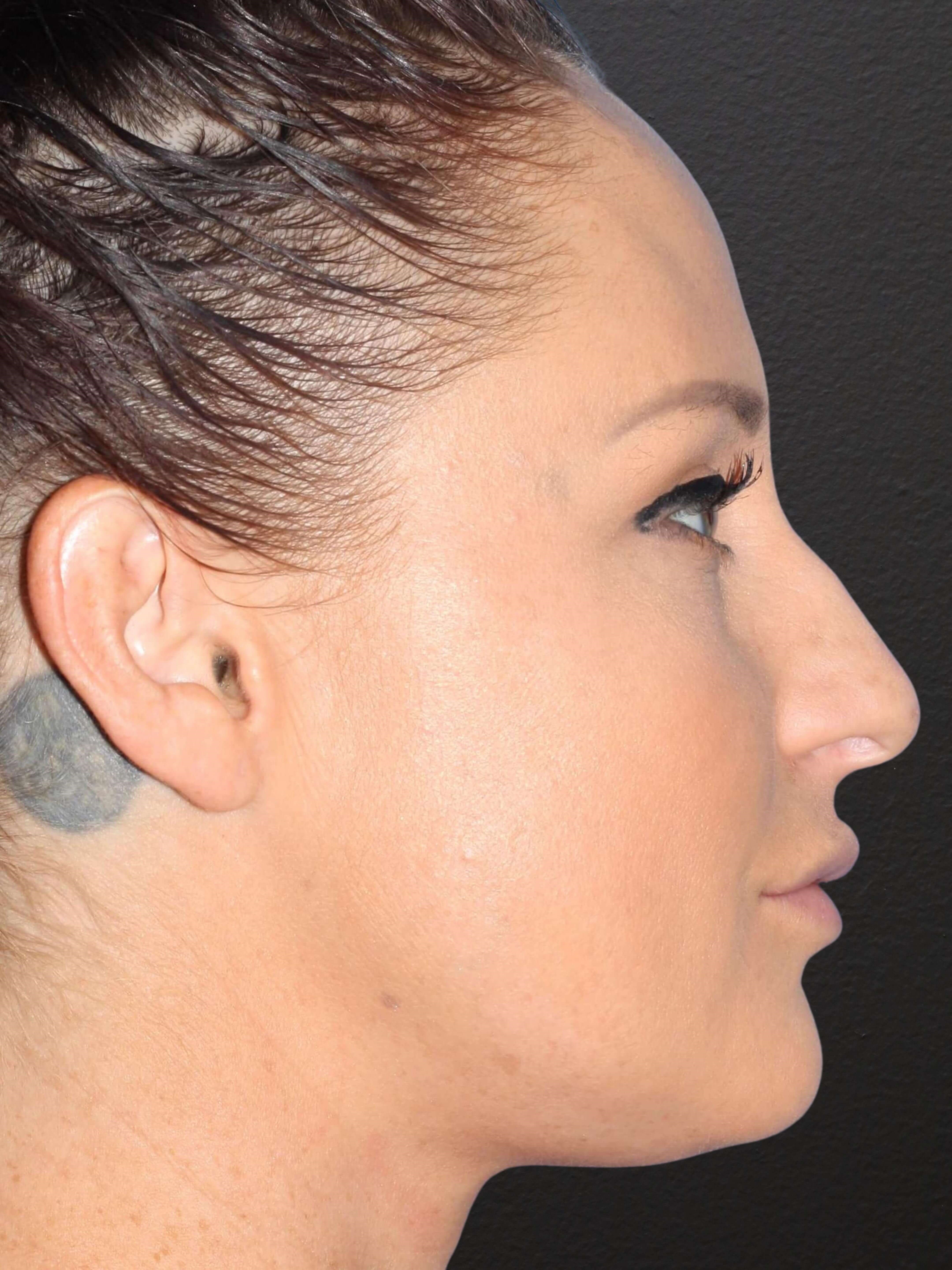 Right lateral Before