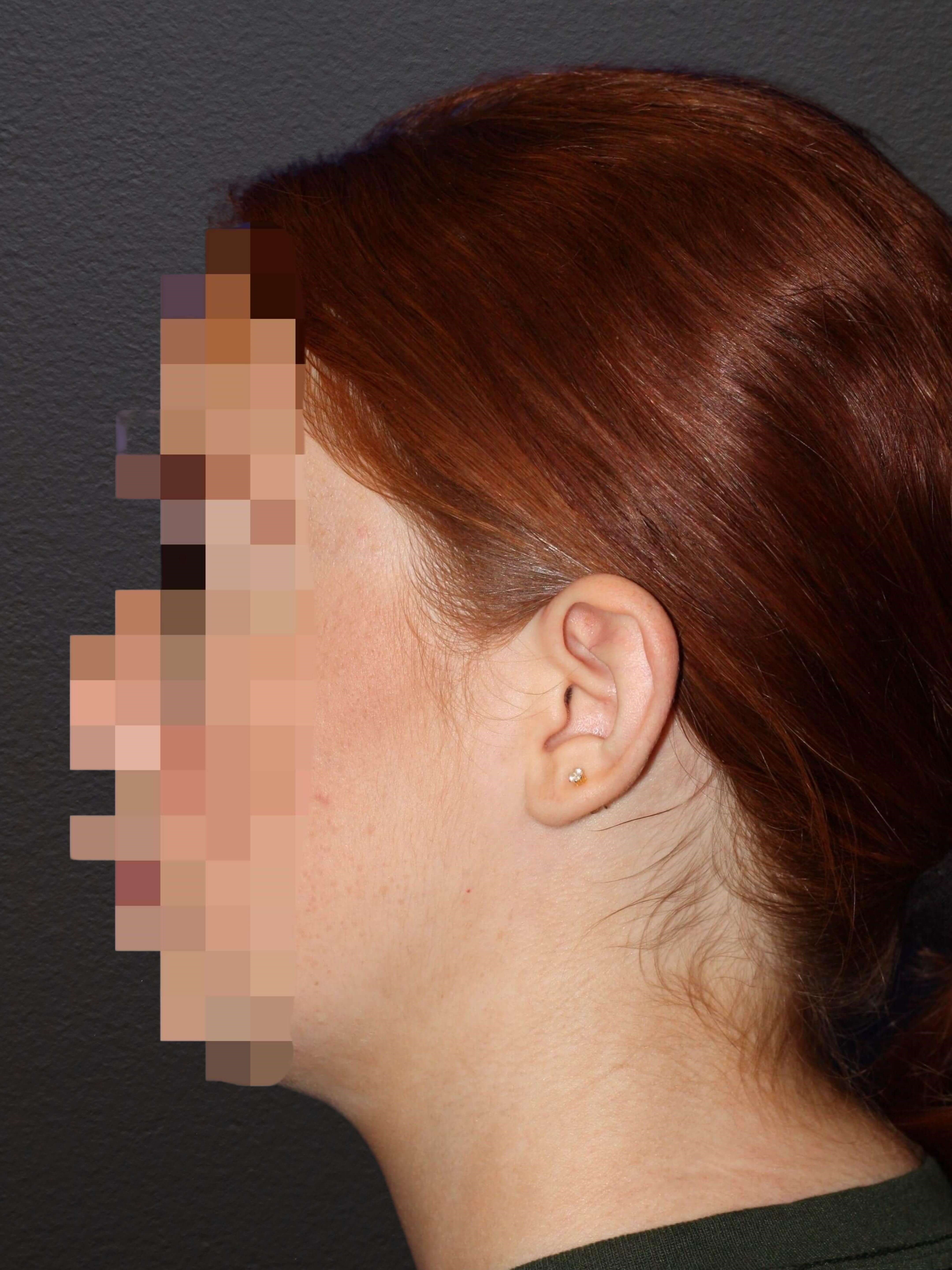 LEFT LATERAL Before