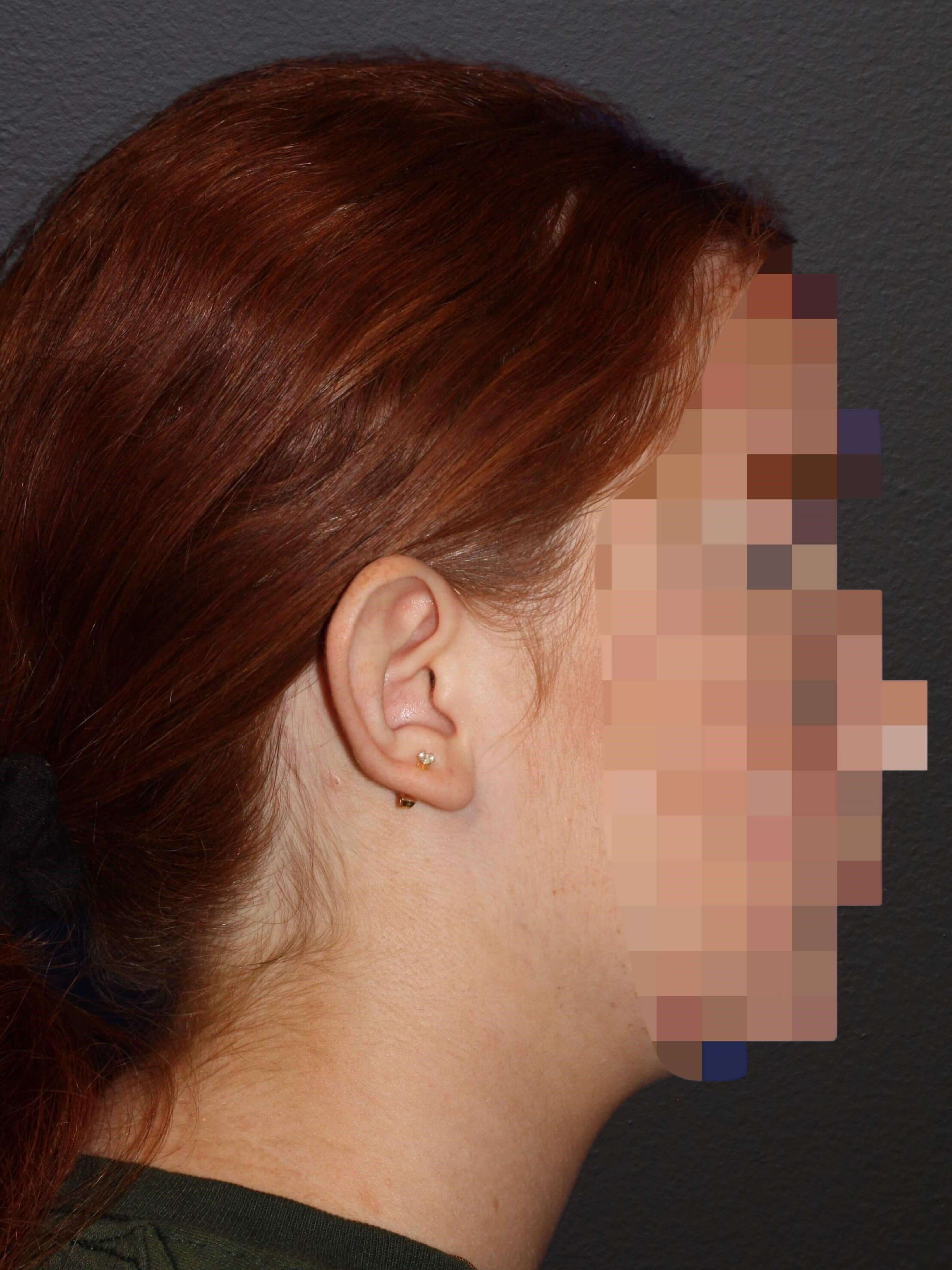 RIGHT LATERAL Before