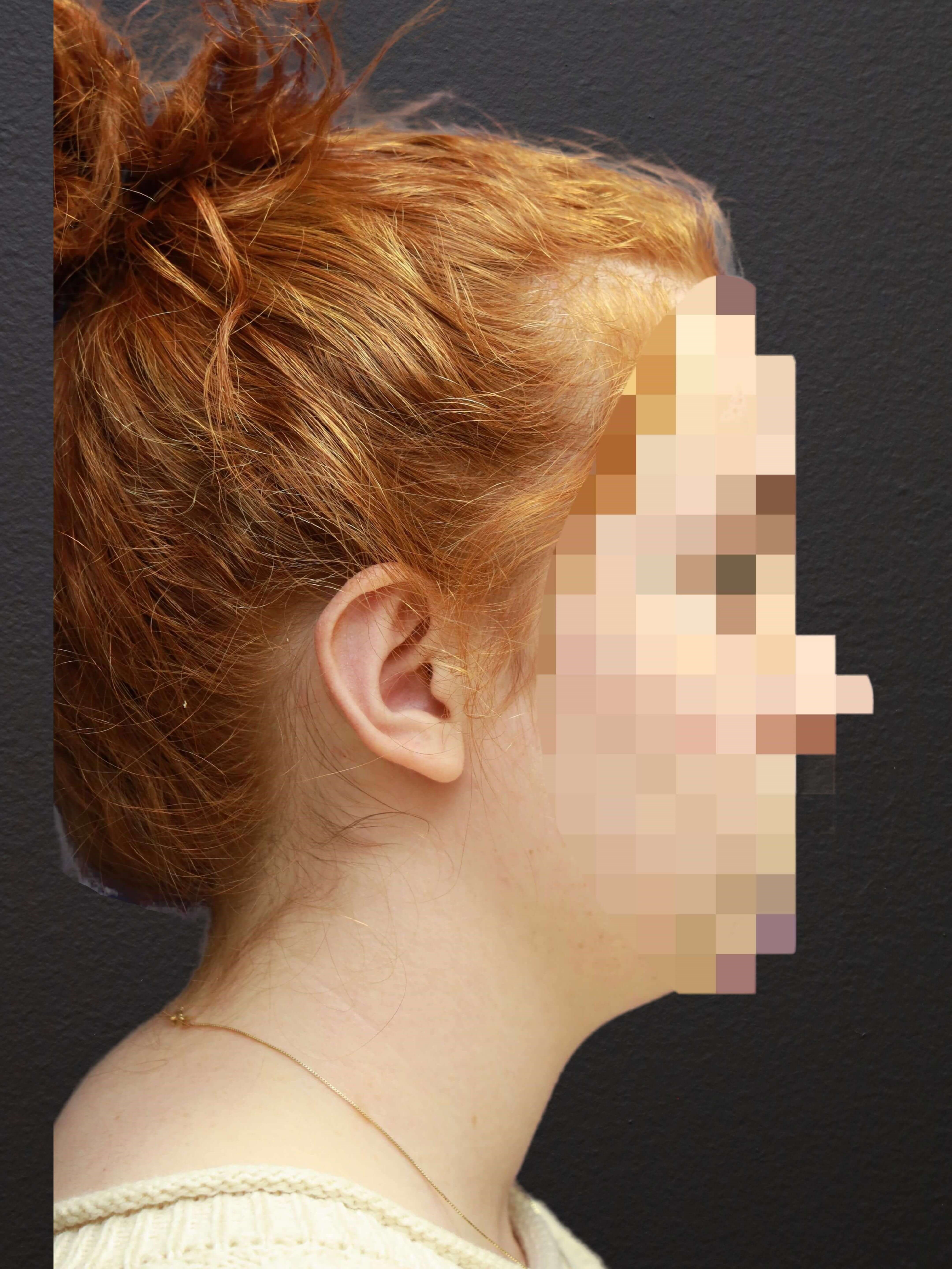 RIGHT LATERAL After