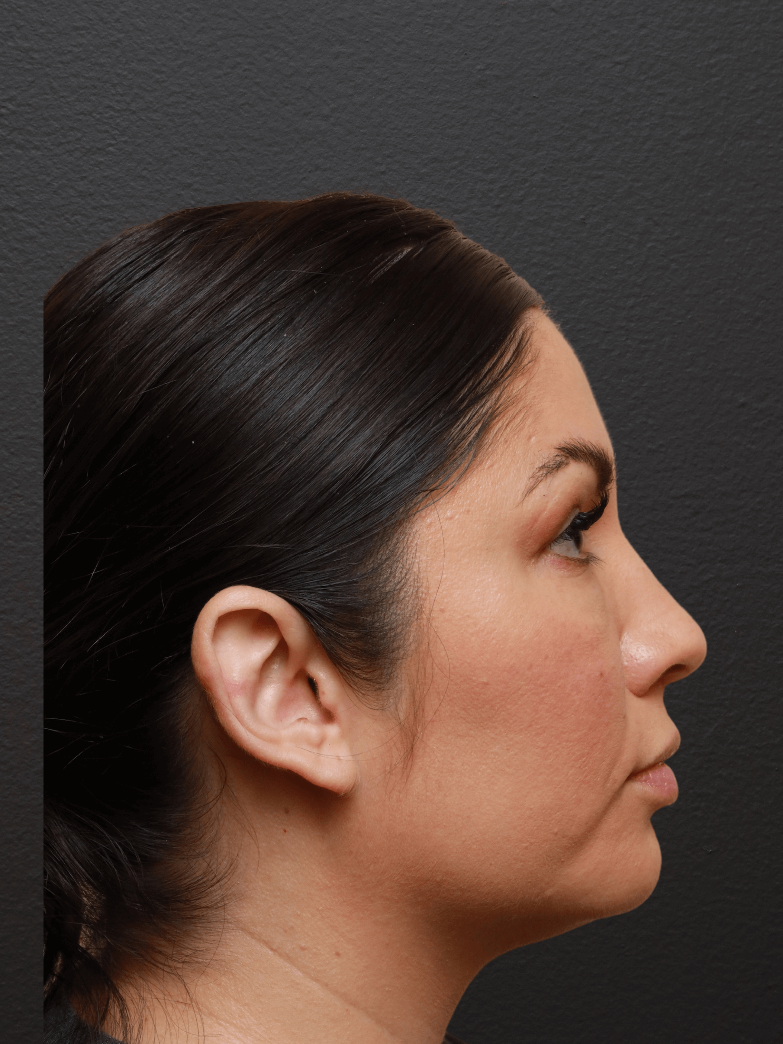 Right Lateral Before