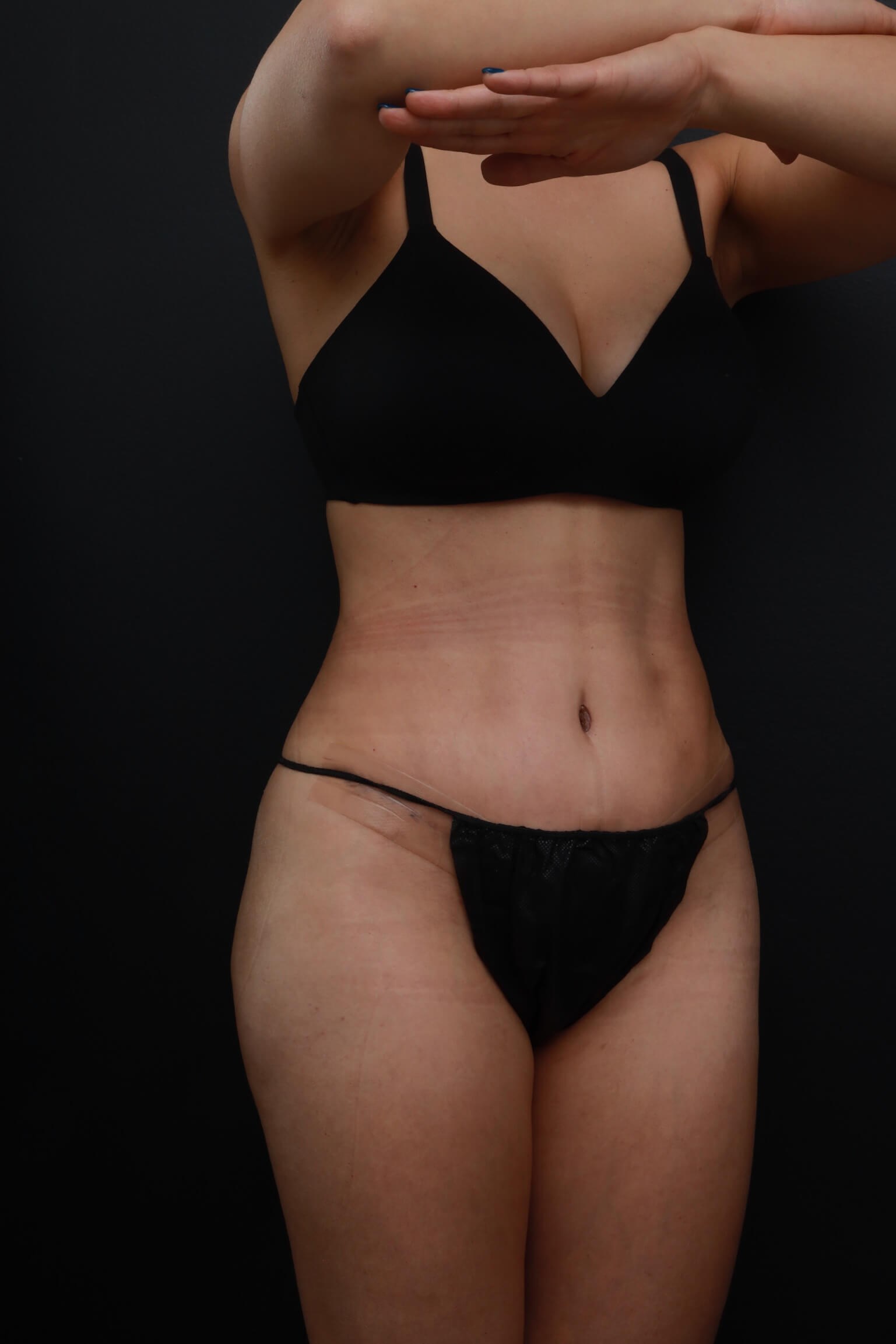 Right Oblique After