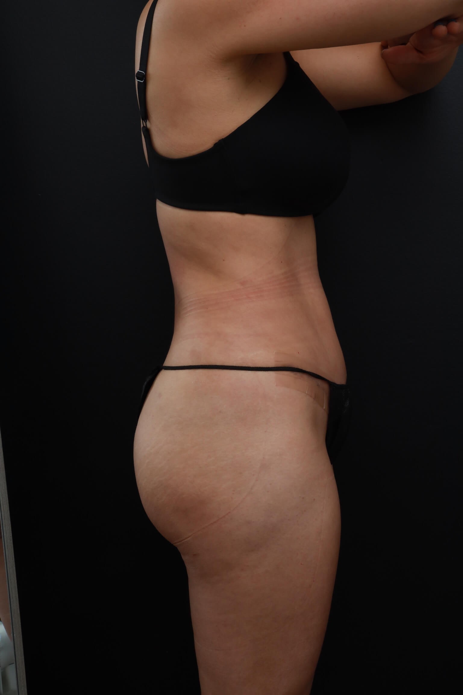 Right Lateral After
