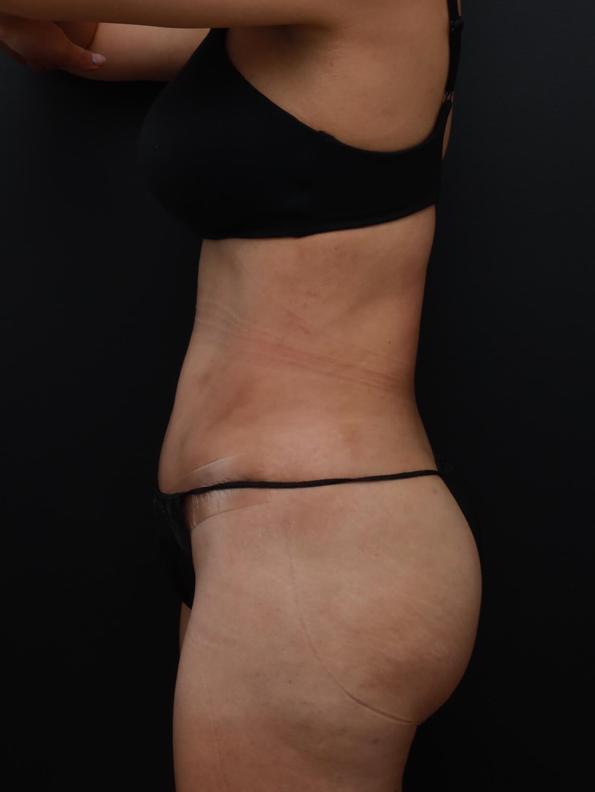 Left Lateral After