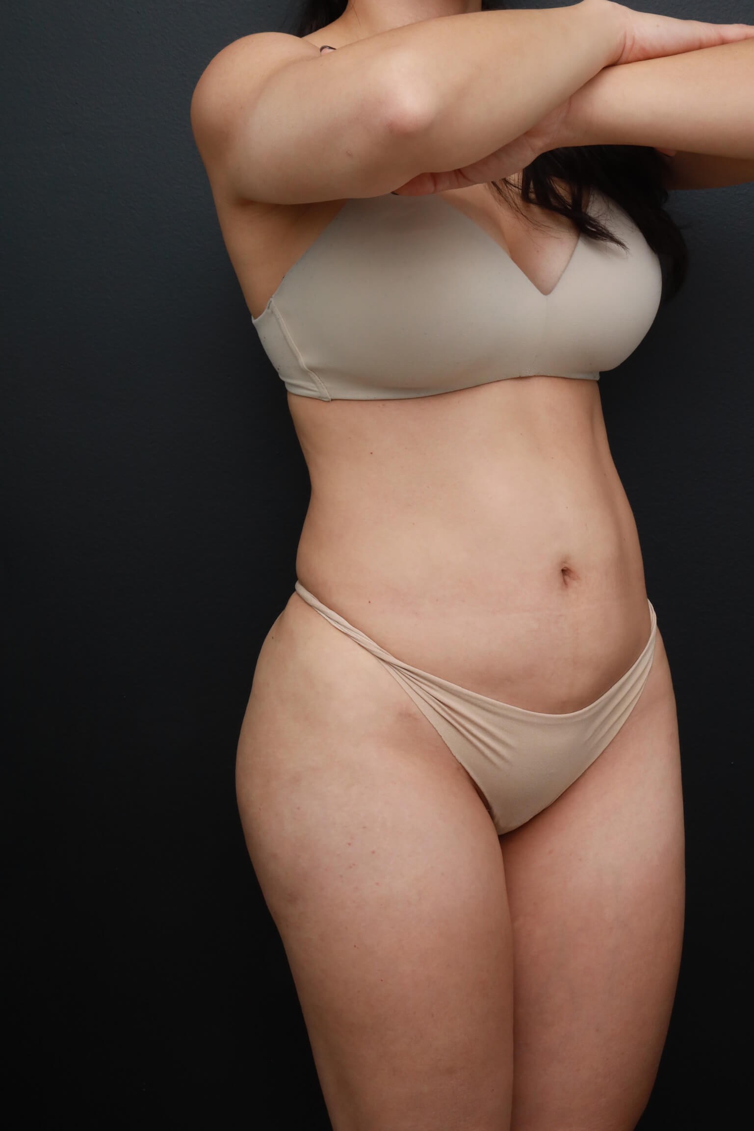 Right Oblique Before