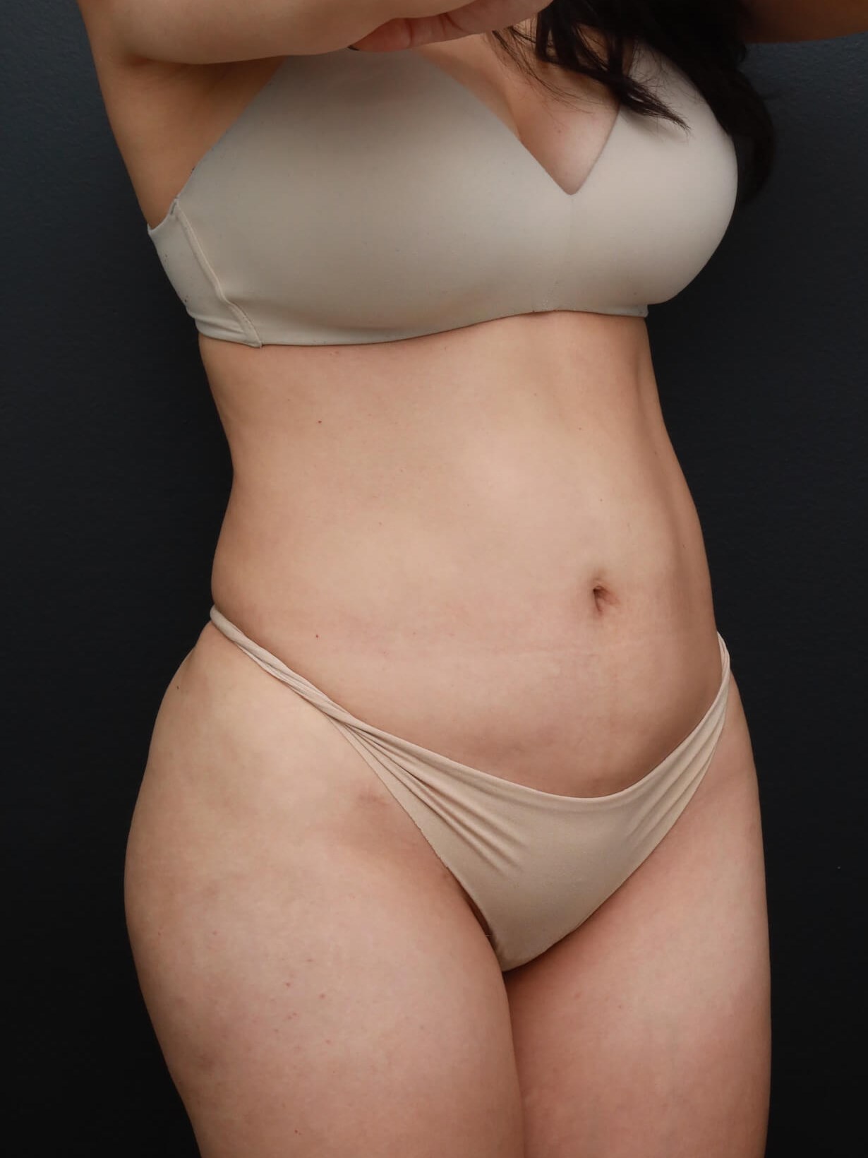Right Oblique Before