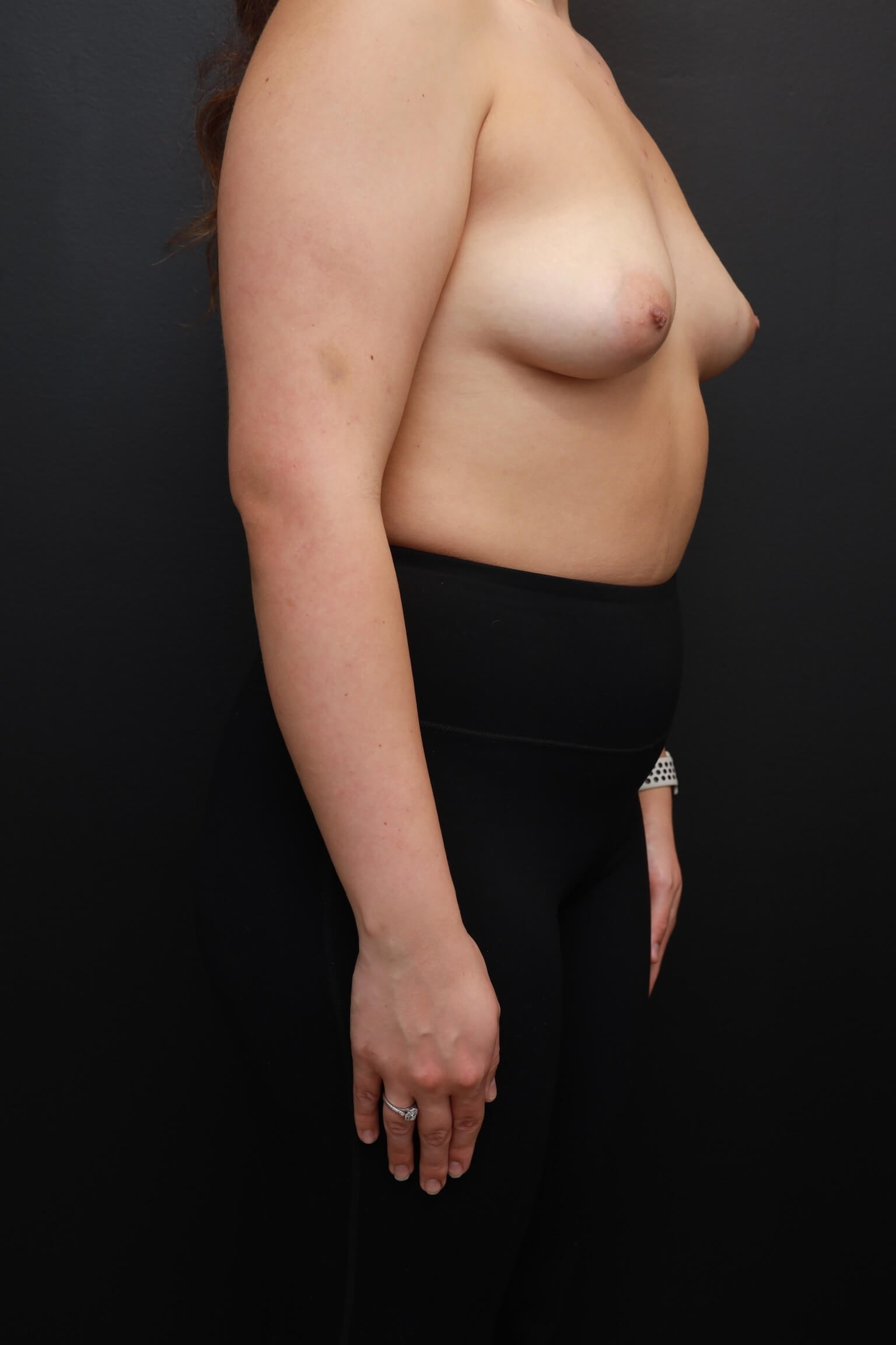 Right Oblique Before Right Oblique