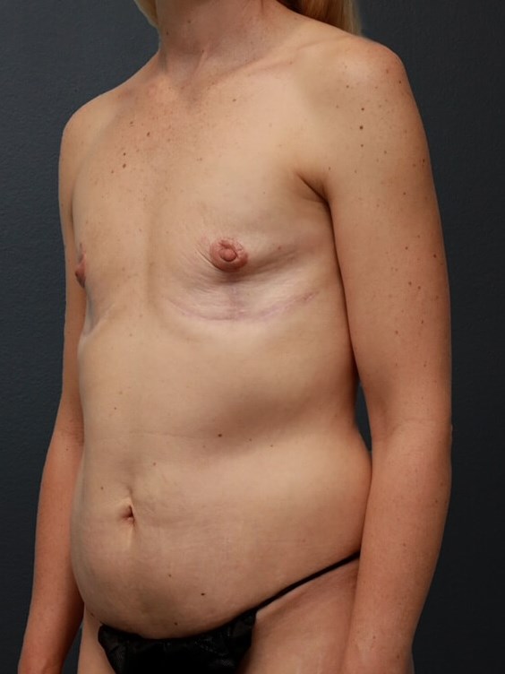 Left Oblique Before Left Oblique