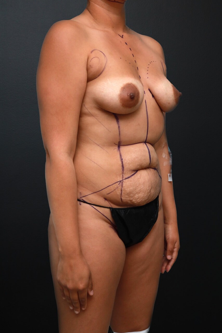 Right Oblique Before