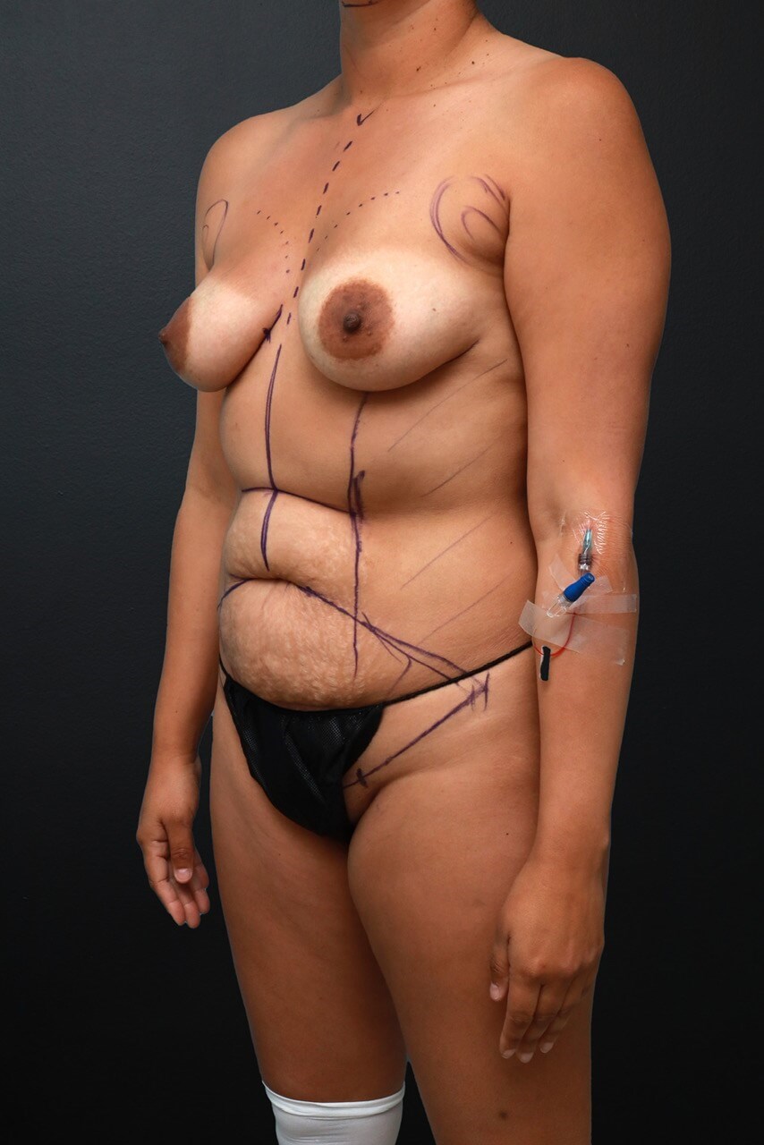 Left Oblique Before