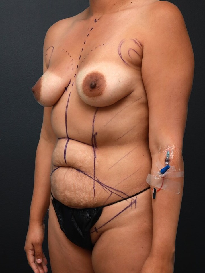 Left Oblique Before